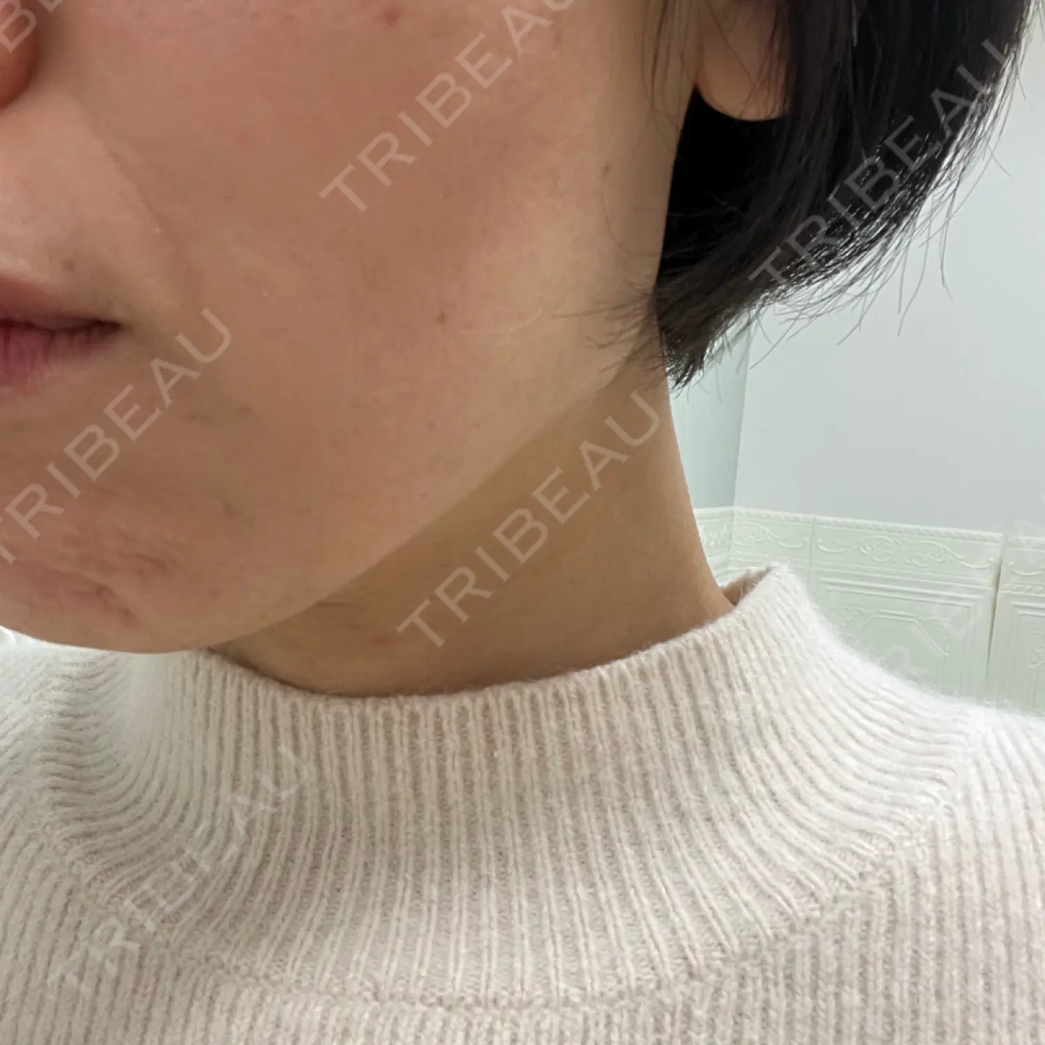 施術後の写真