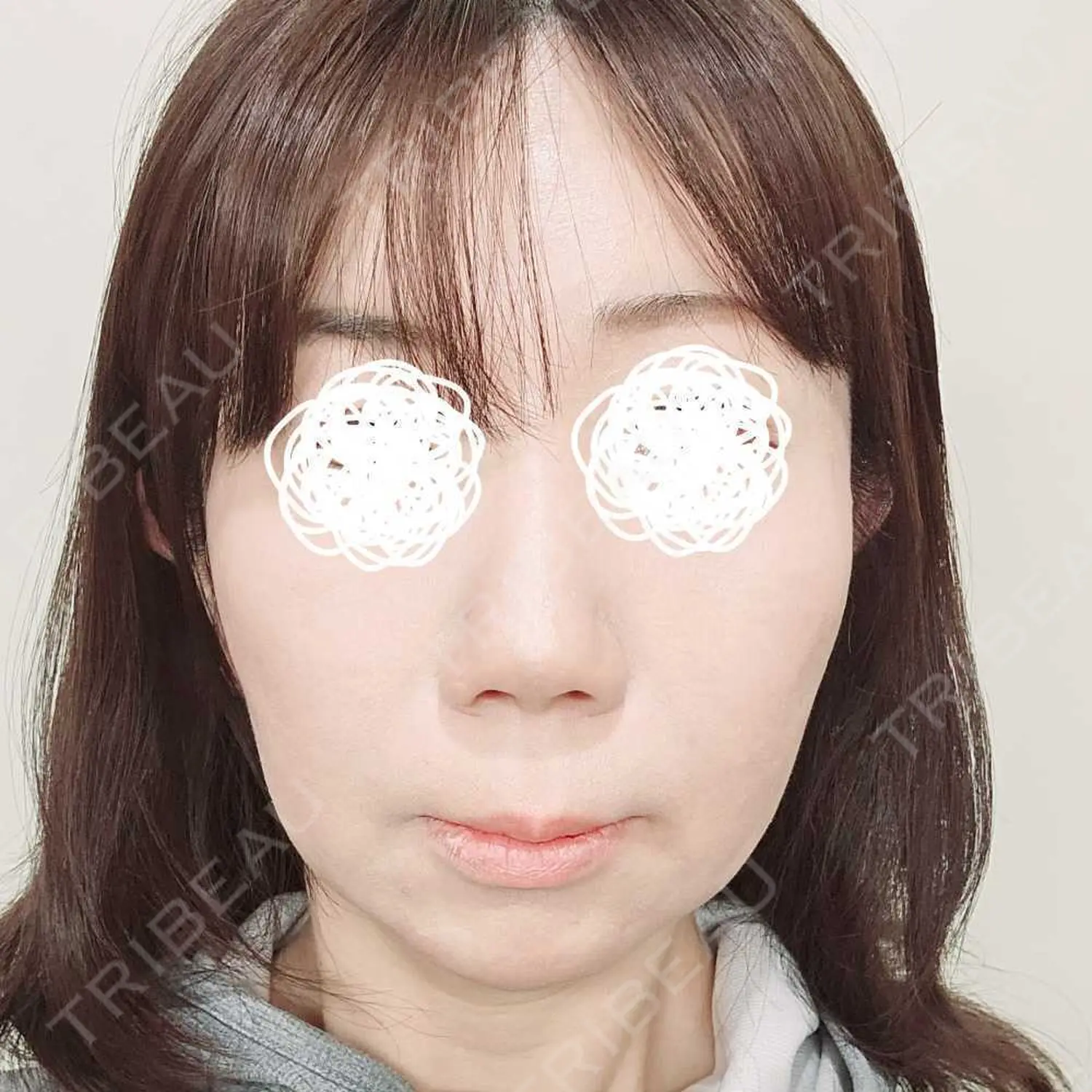施術後の写真