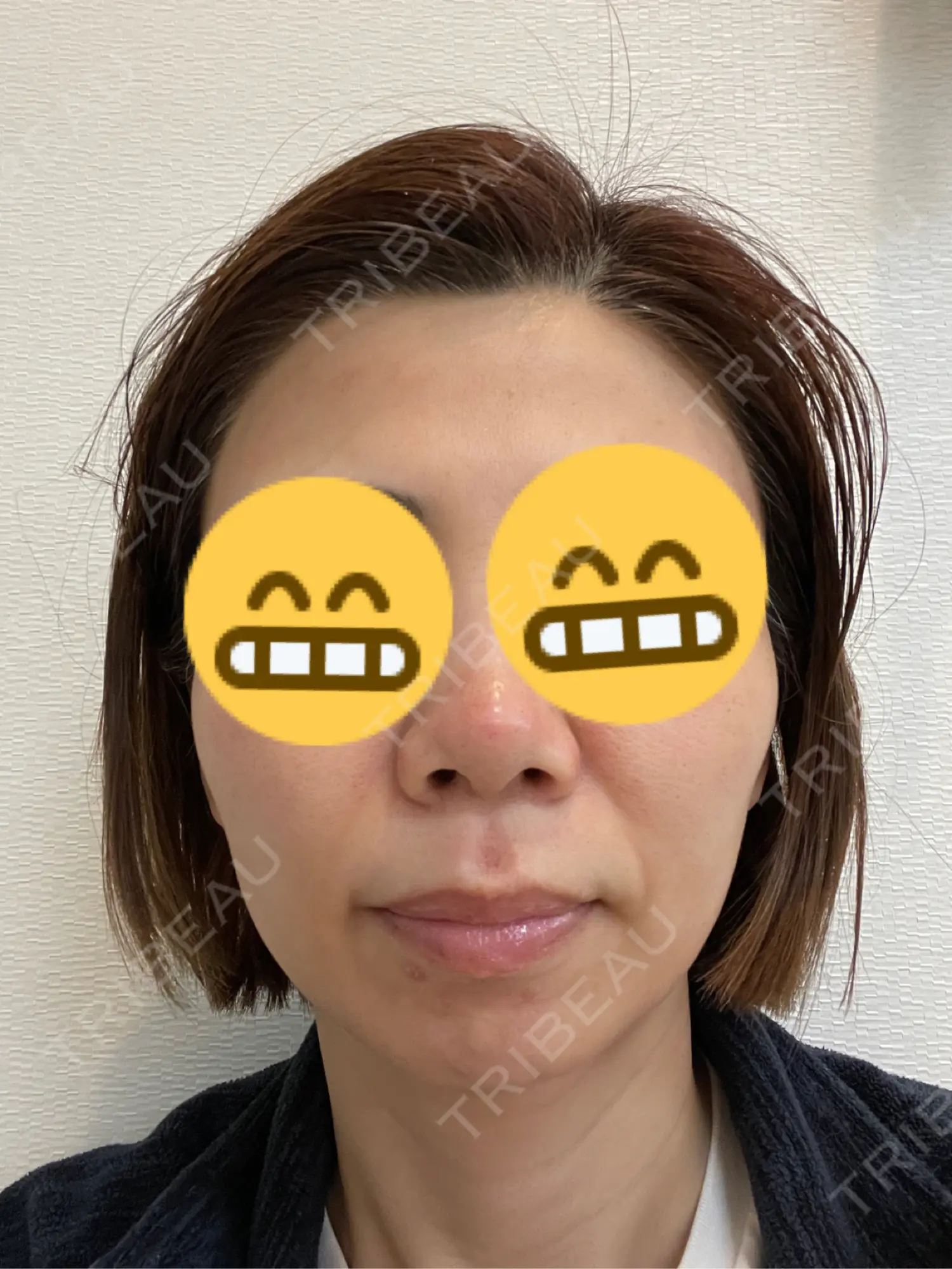 施術後の写真