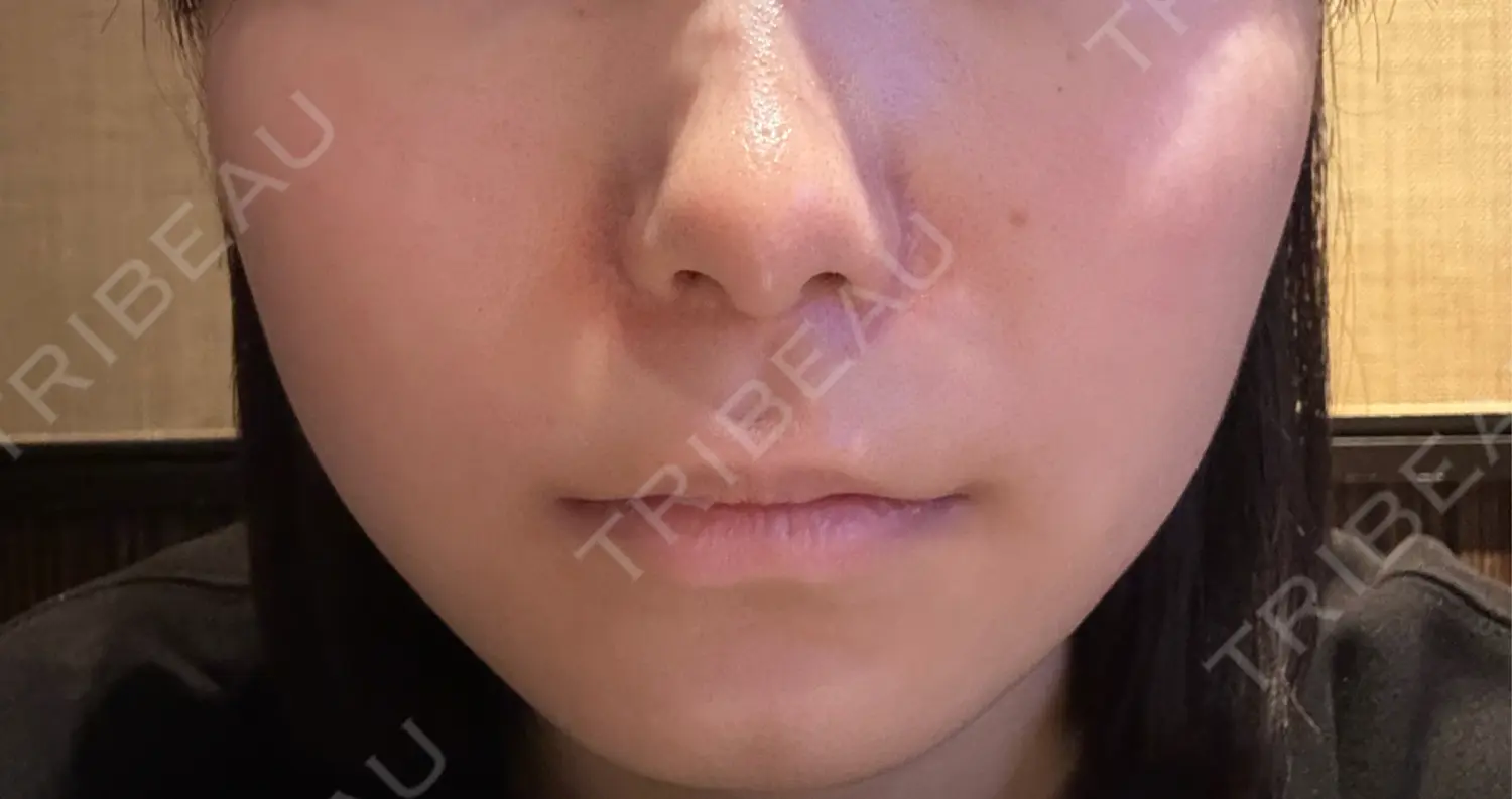 施術後の写真