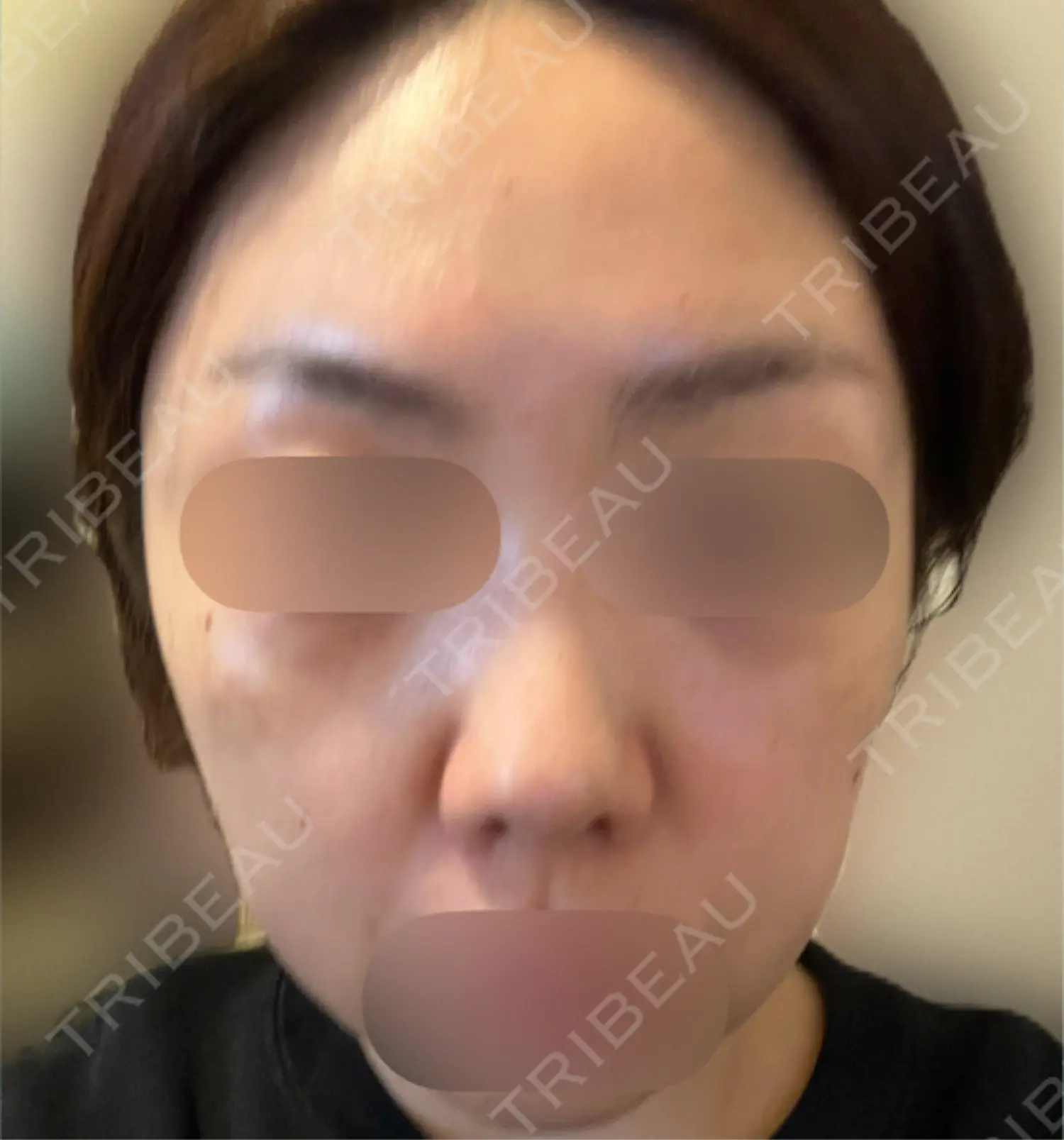 施術後の写真