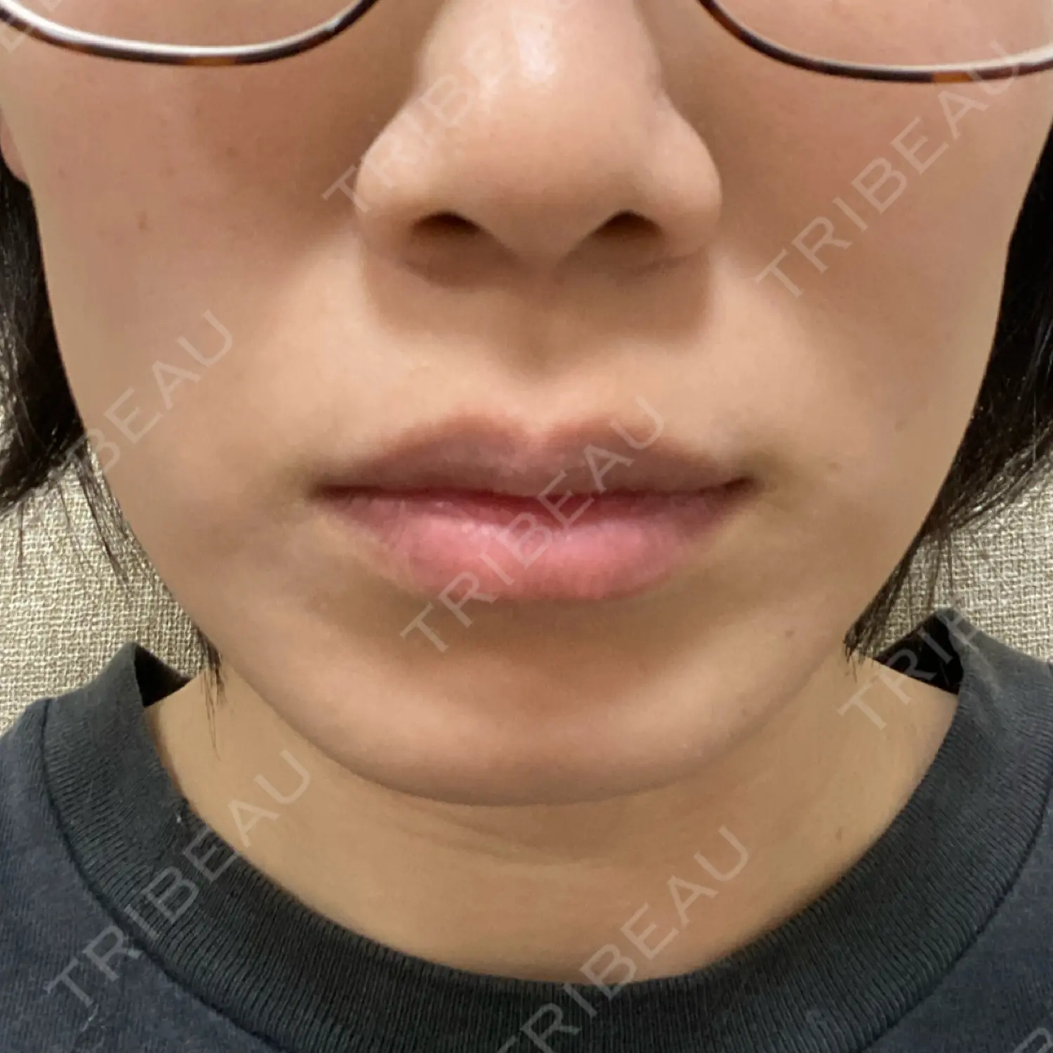 施術後の写真