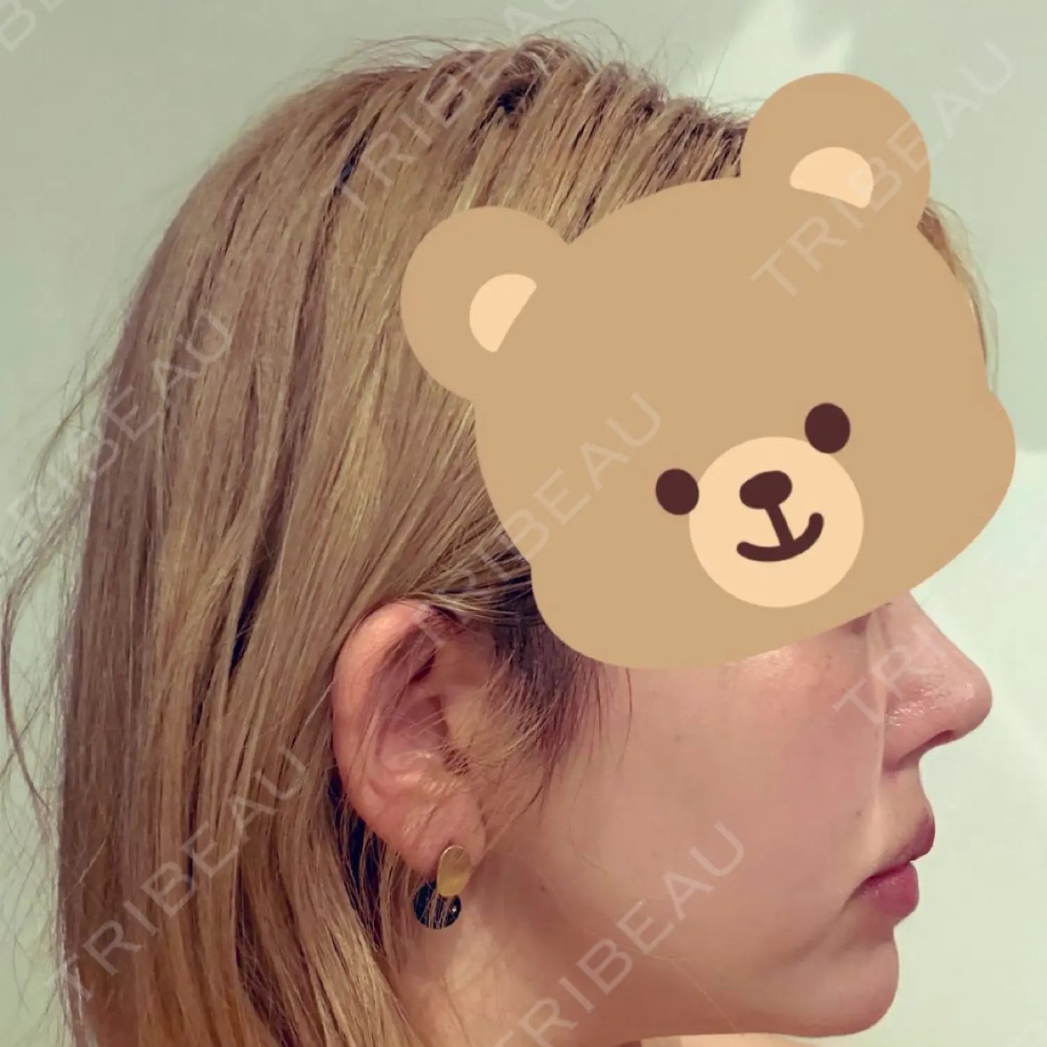 施術後の写真