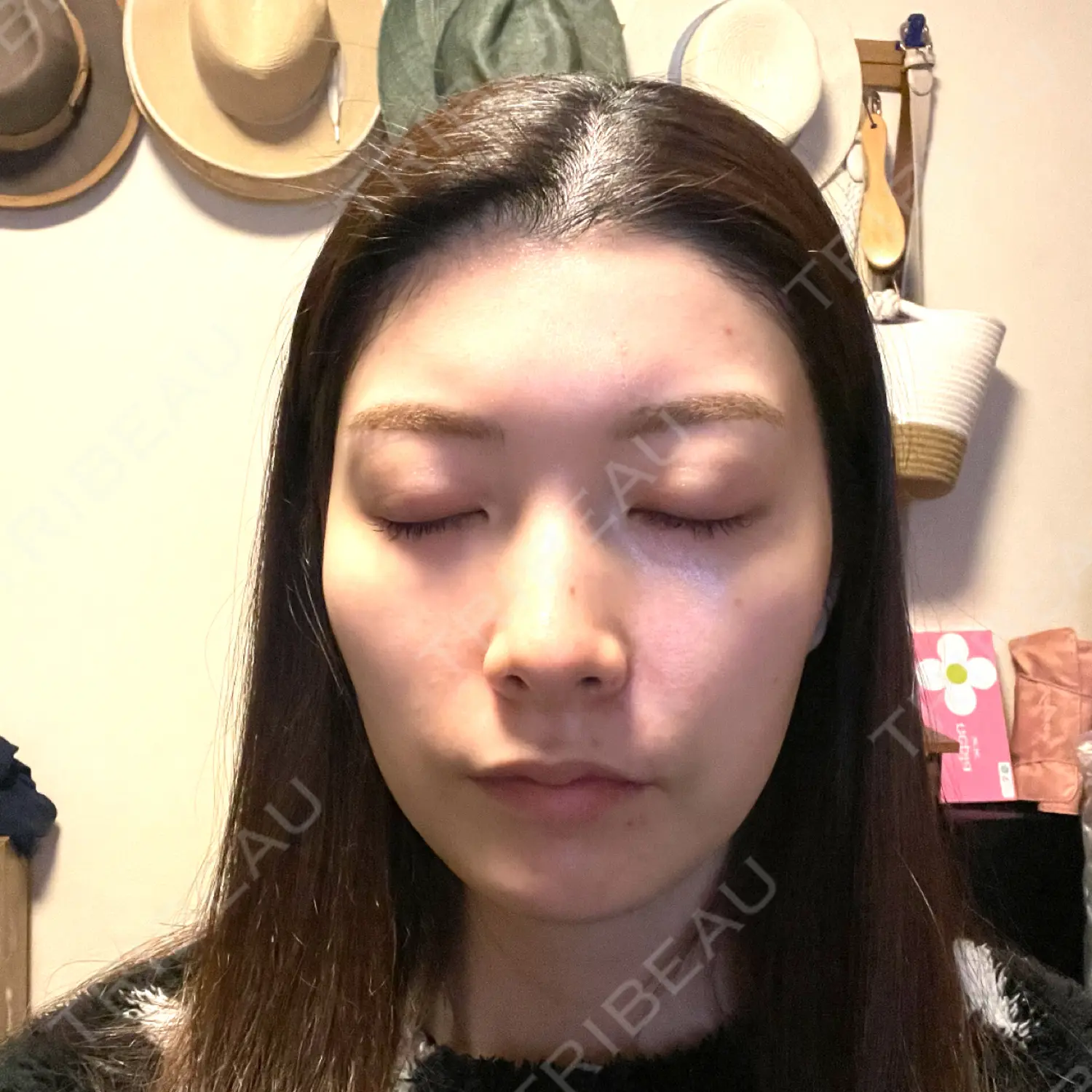 施術後の写真
