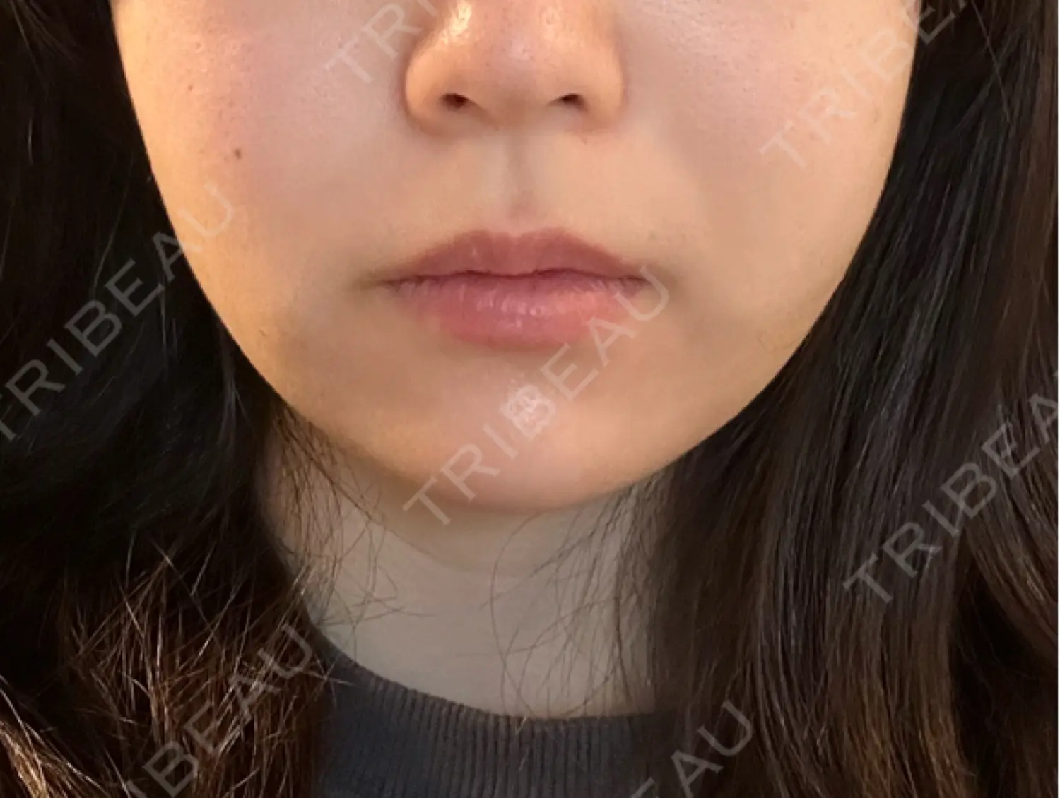 施術後の写真