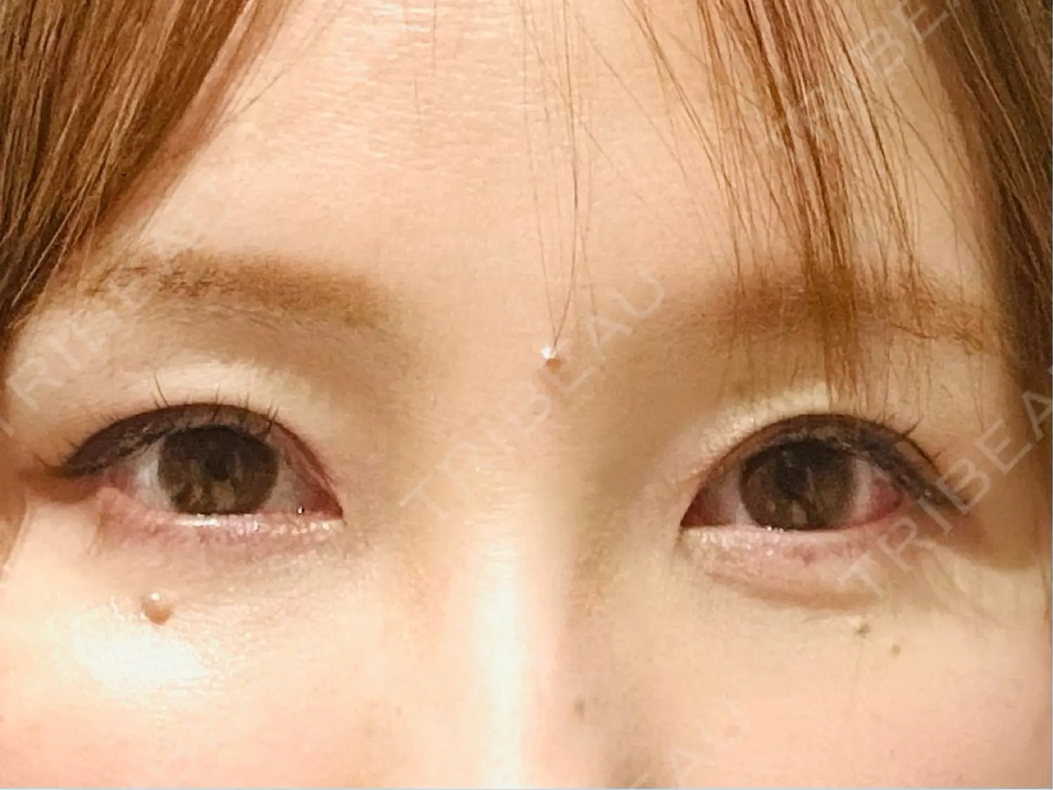 施術後の写真