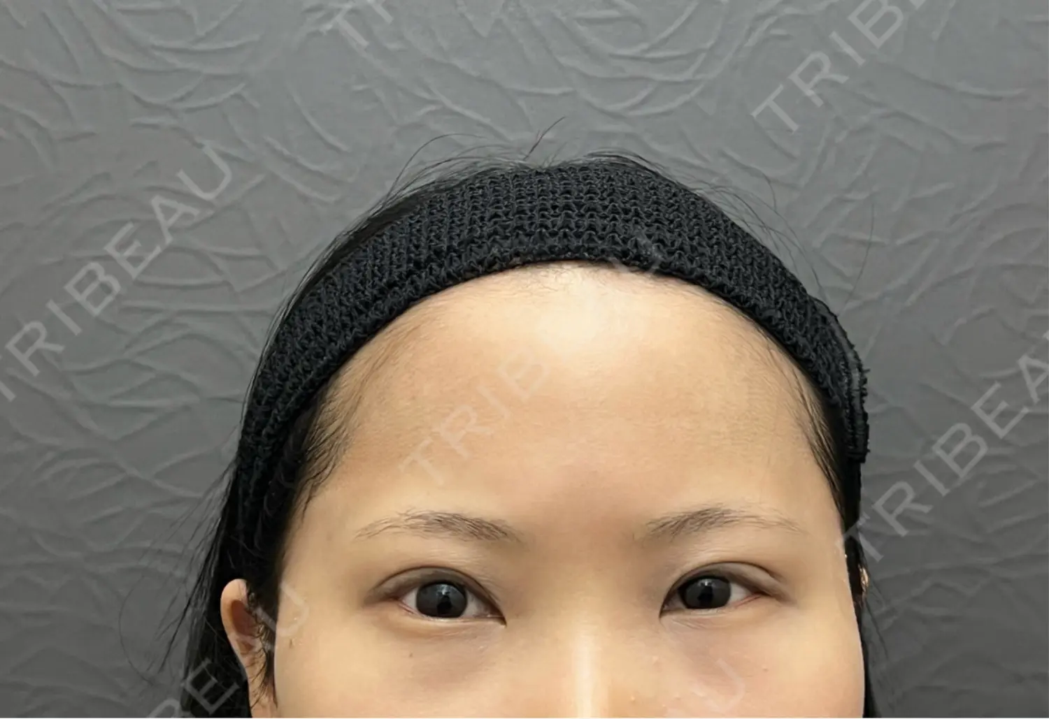 施術後の写真
