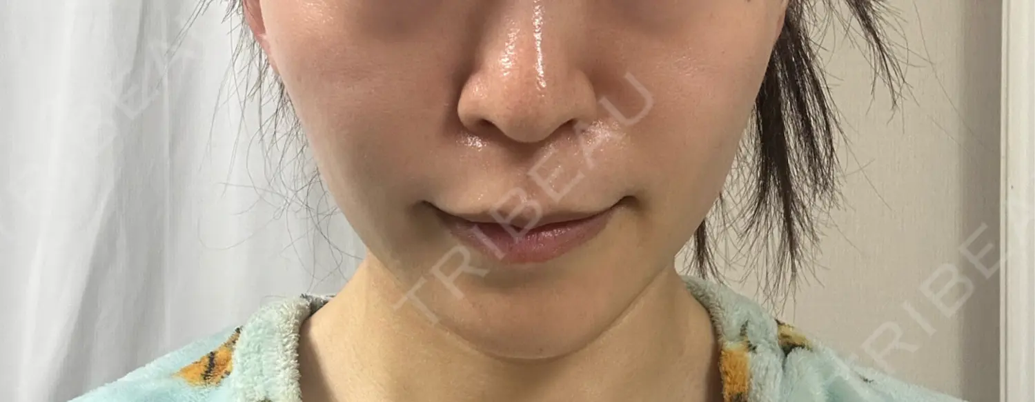 施術後の写真