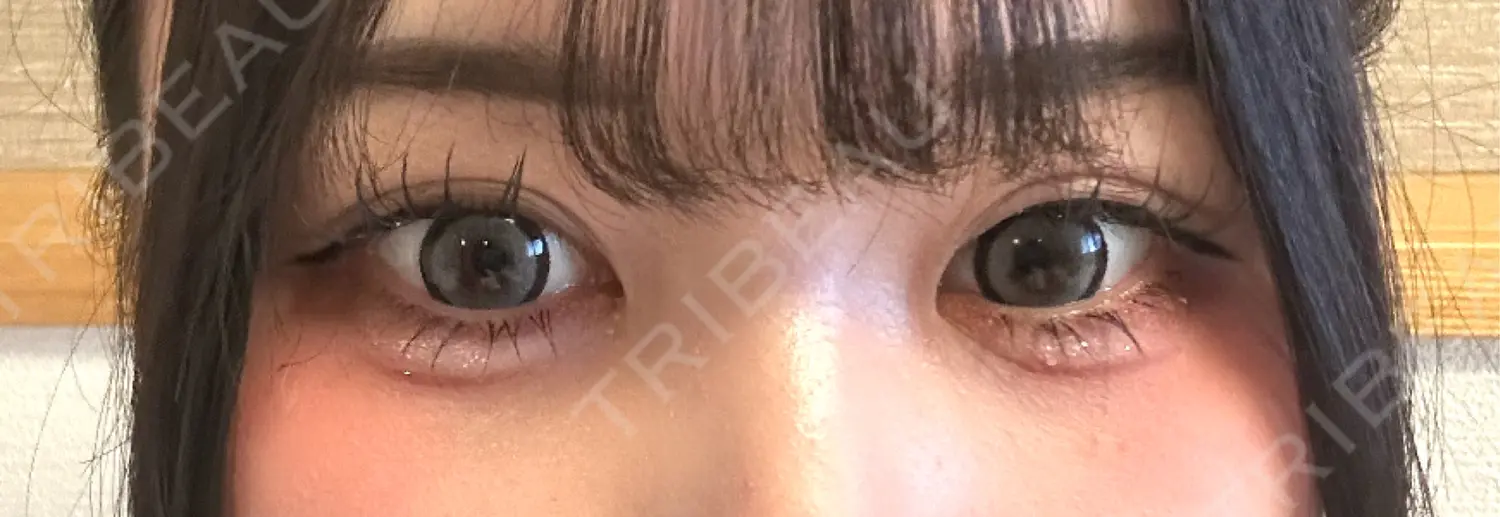 施術後の写真