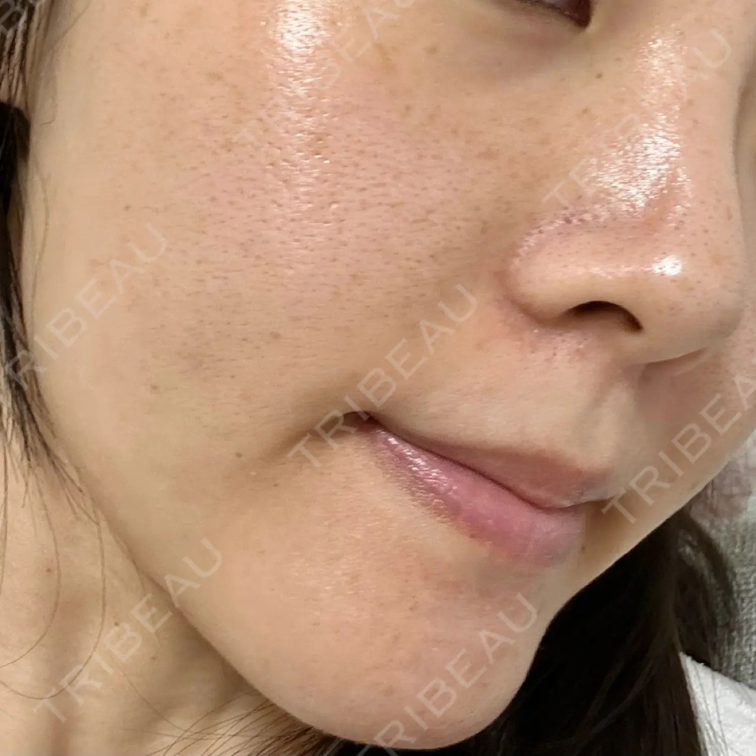 施術後の写真
