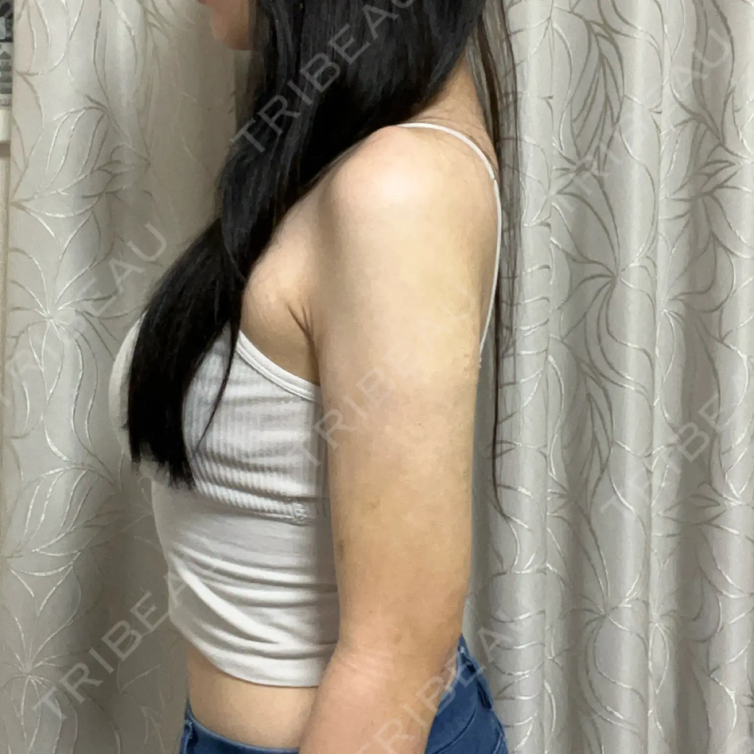 施術後の写真