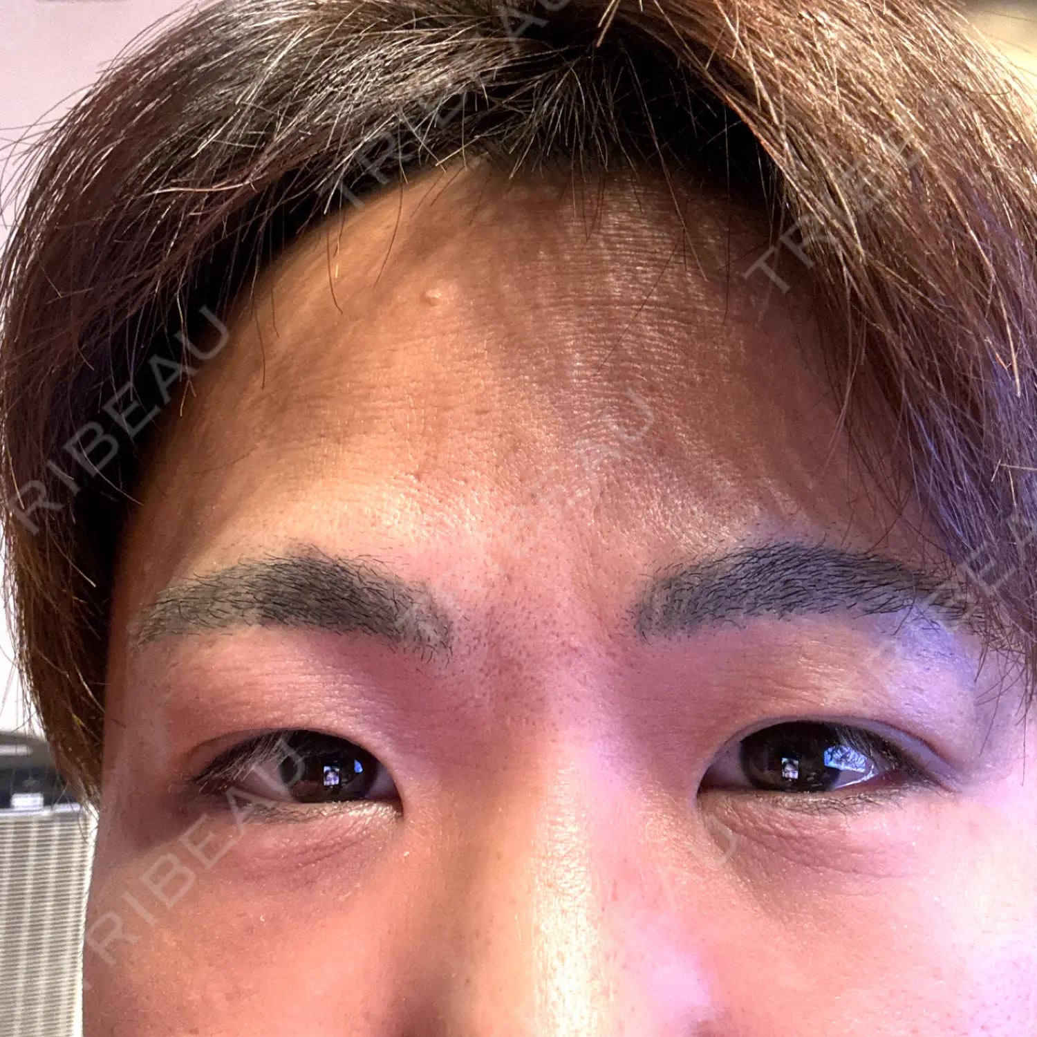 施術後の写真