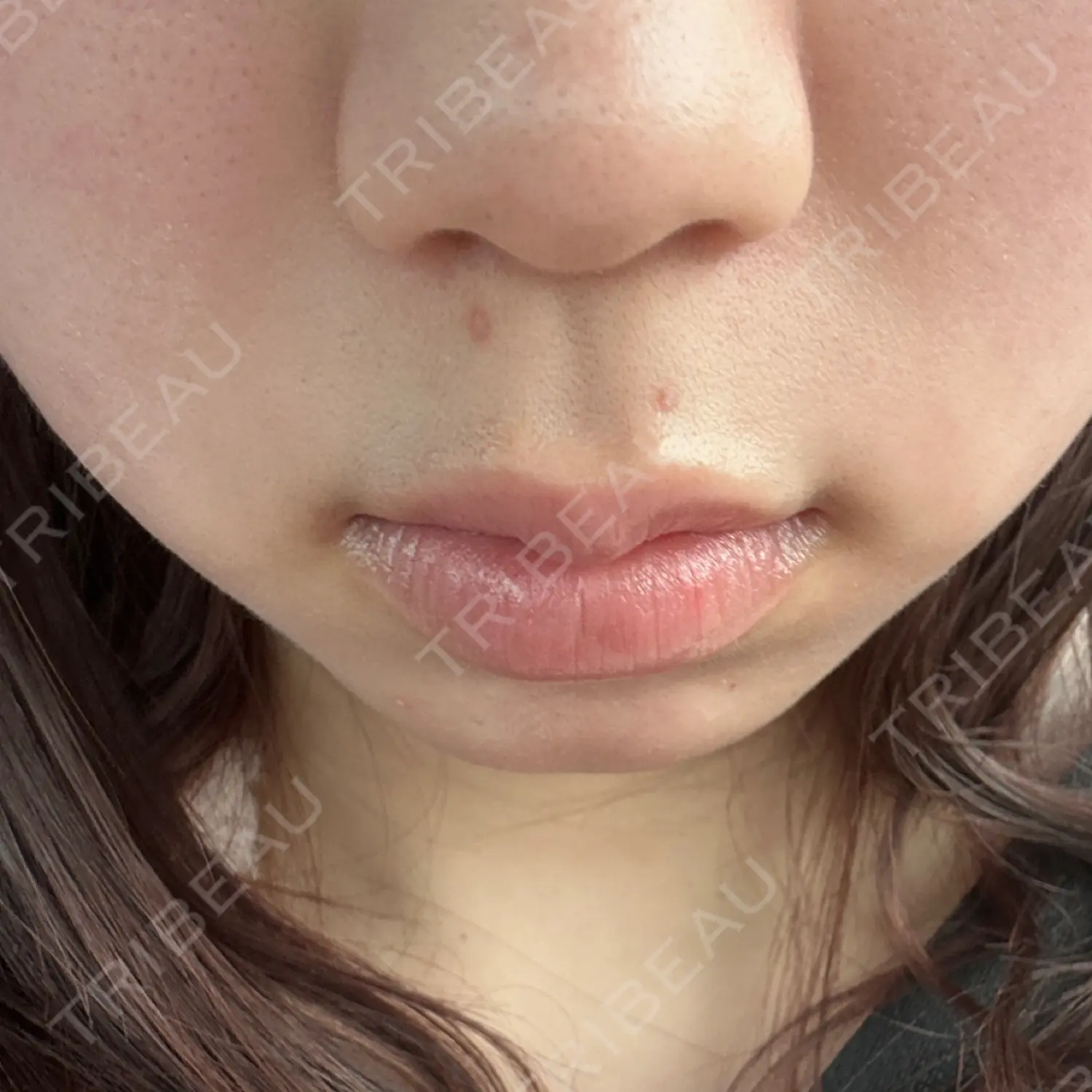 施術後の写真