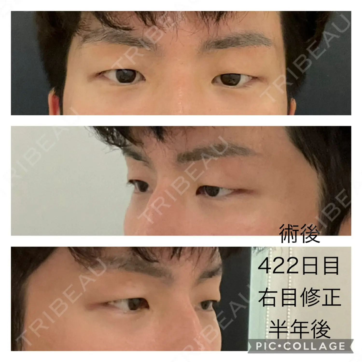 施術後の写真