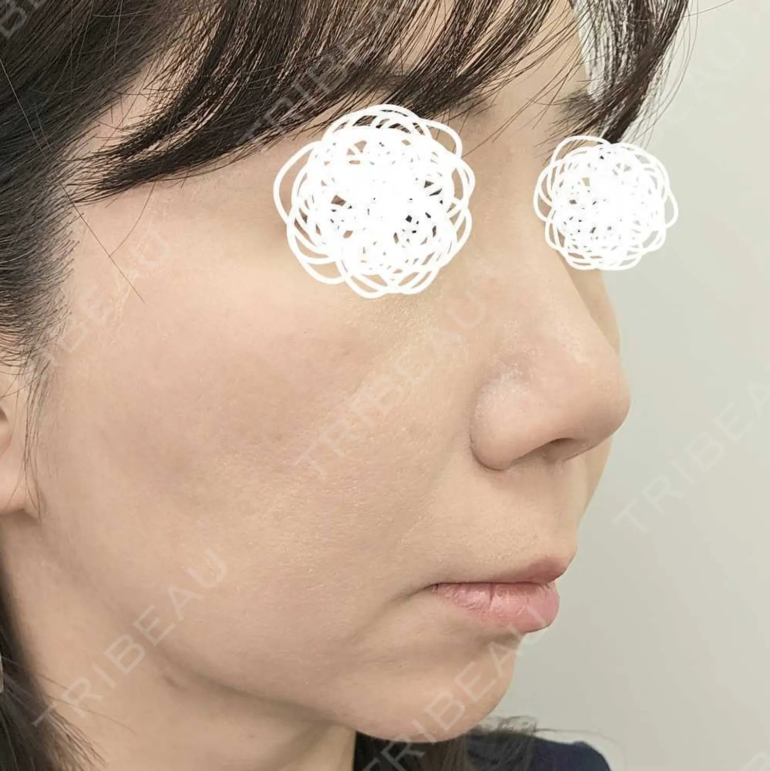 施術後の写真