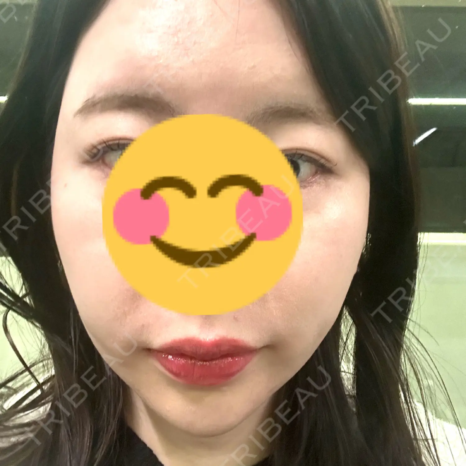 施術後の写真