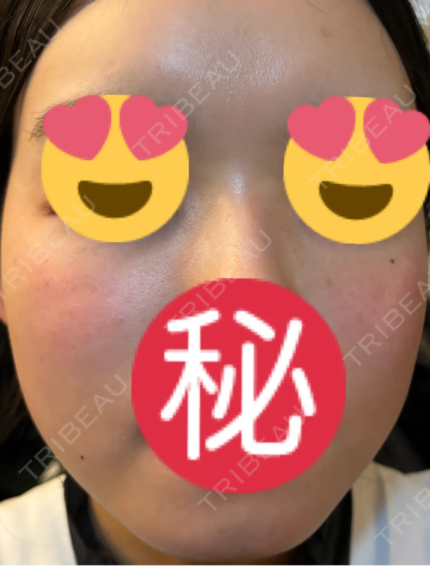 施術後の写真