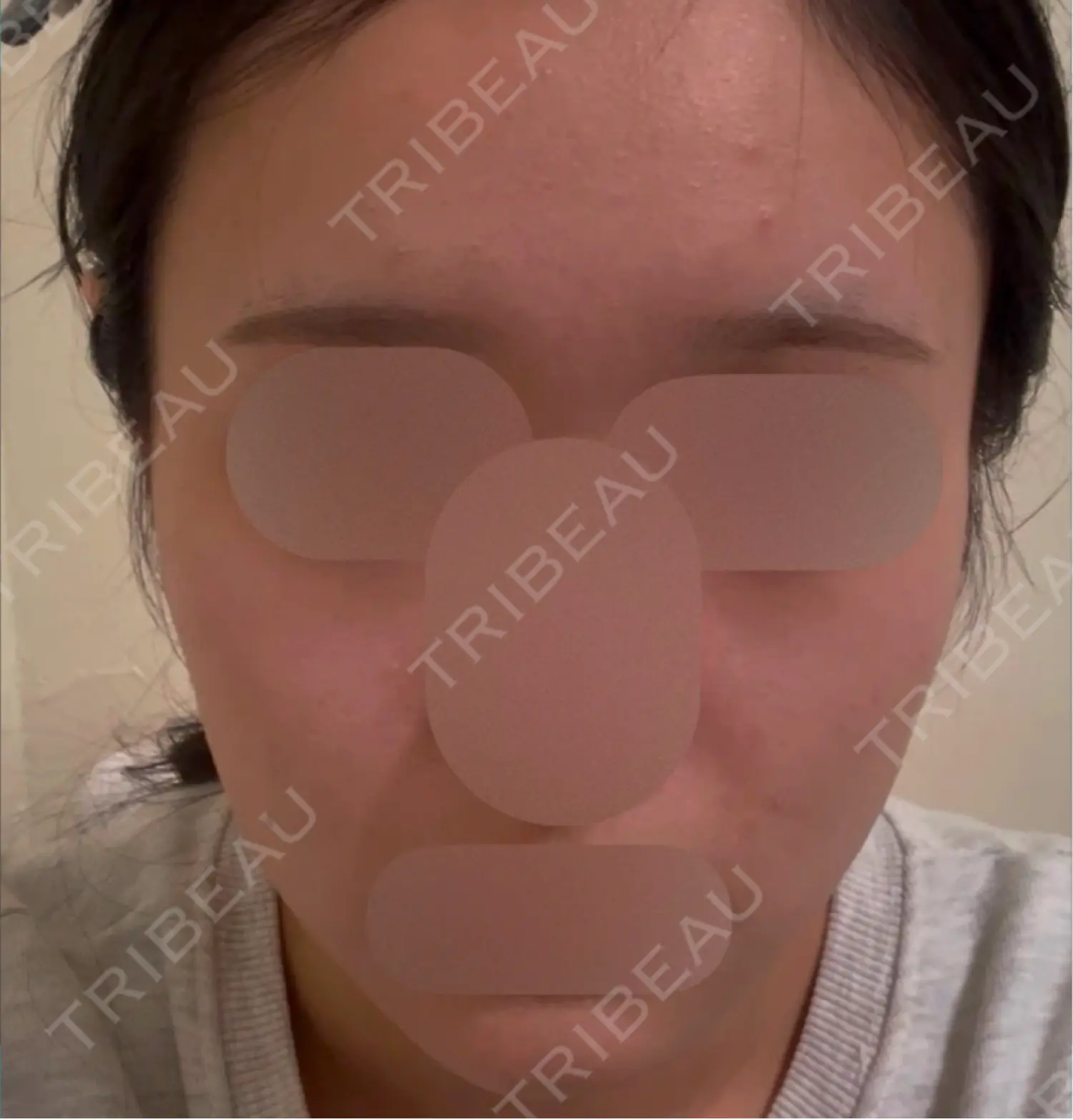 施術後の写真