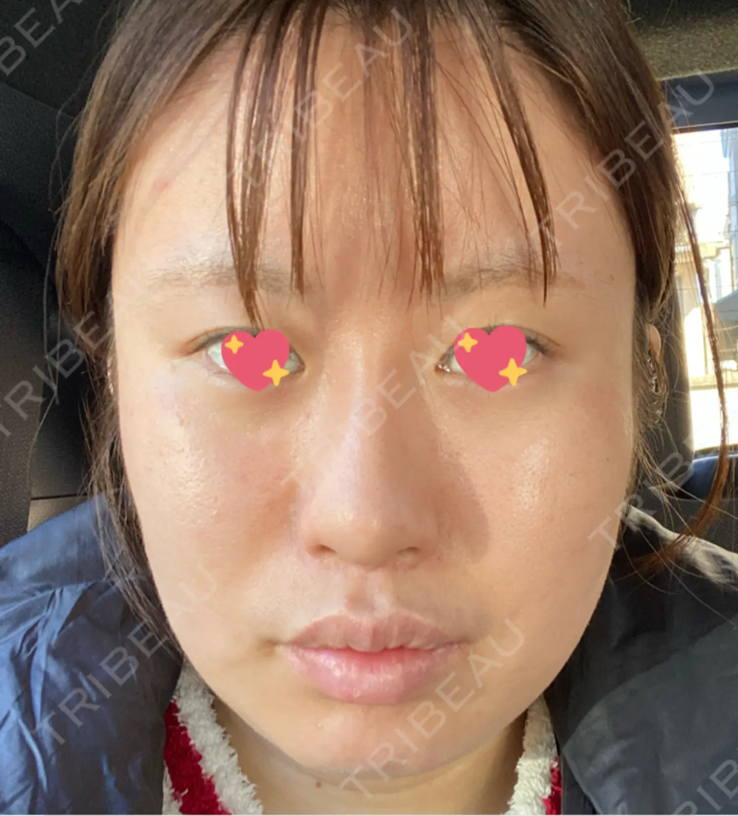 施術後の写真