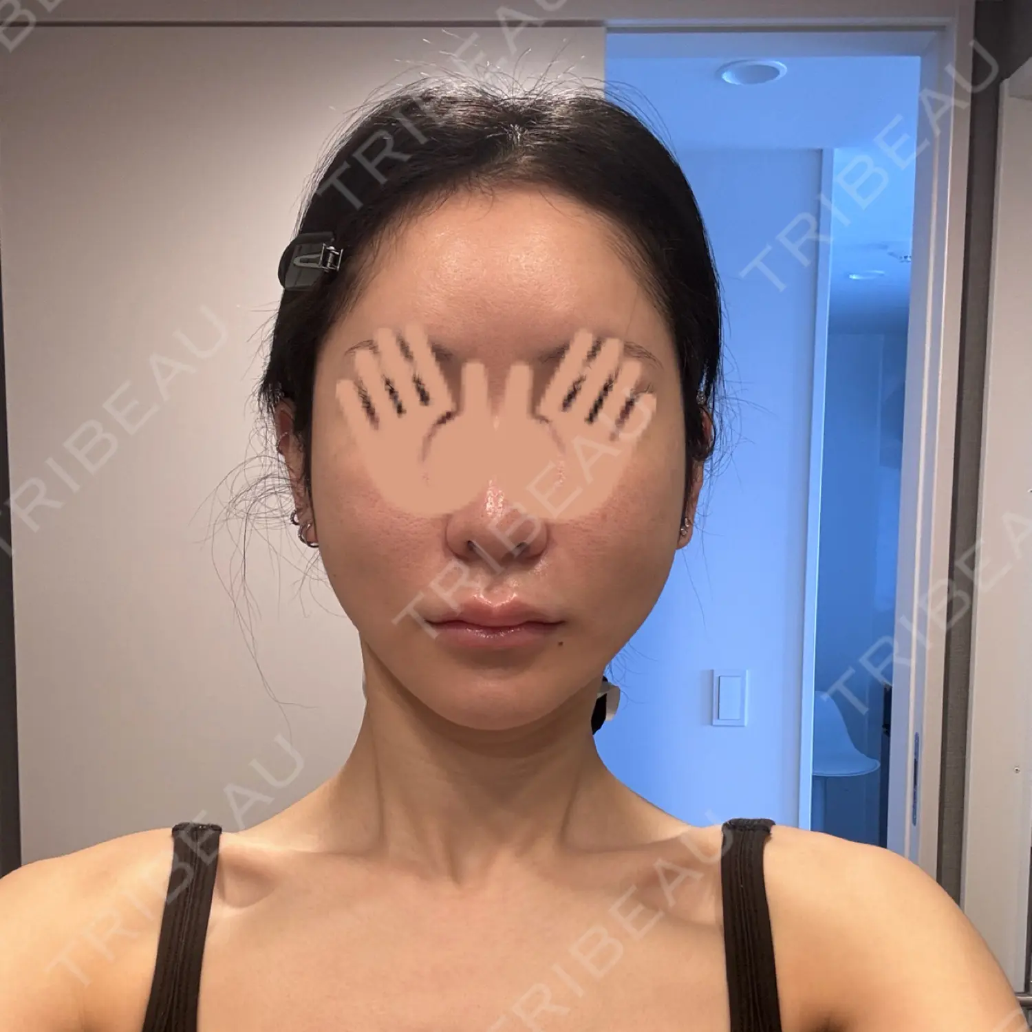 施術後の写真