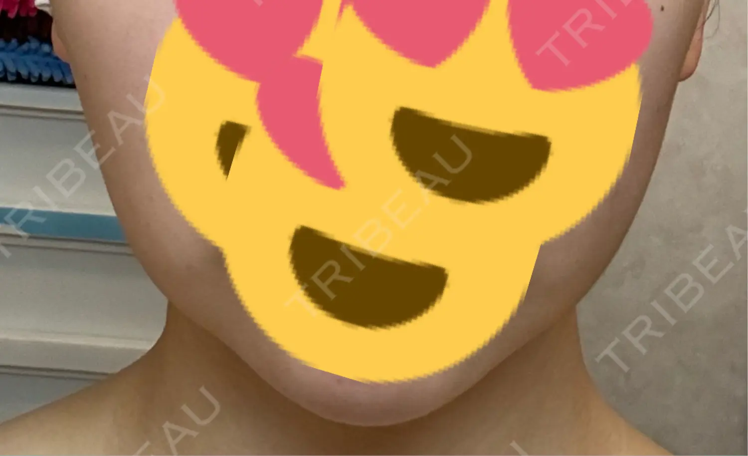 施術後の写真