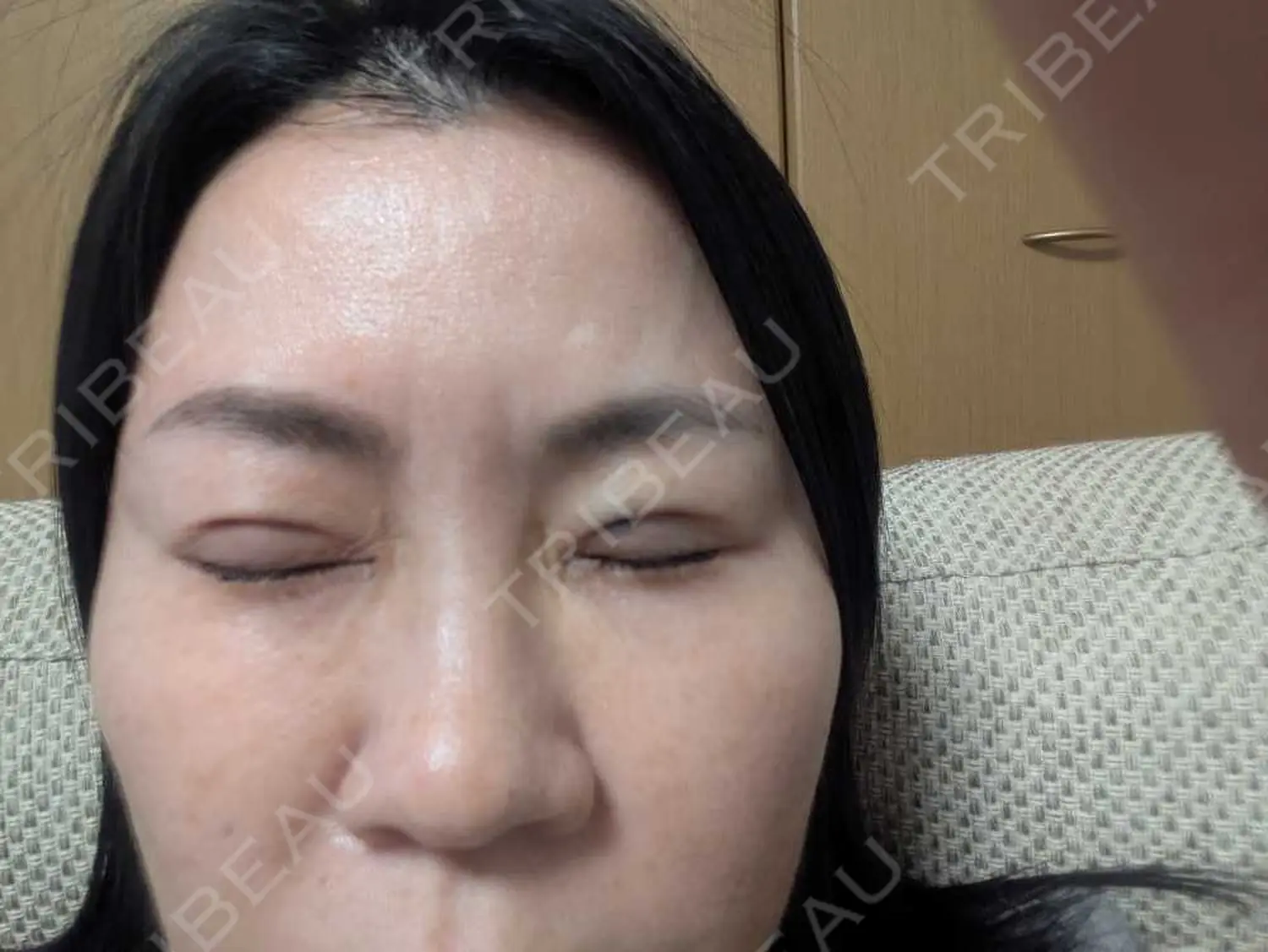 施術後の写真