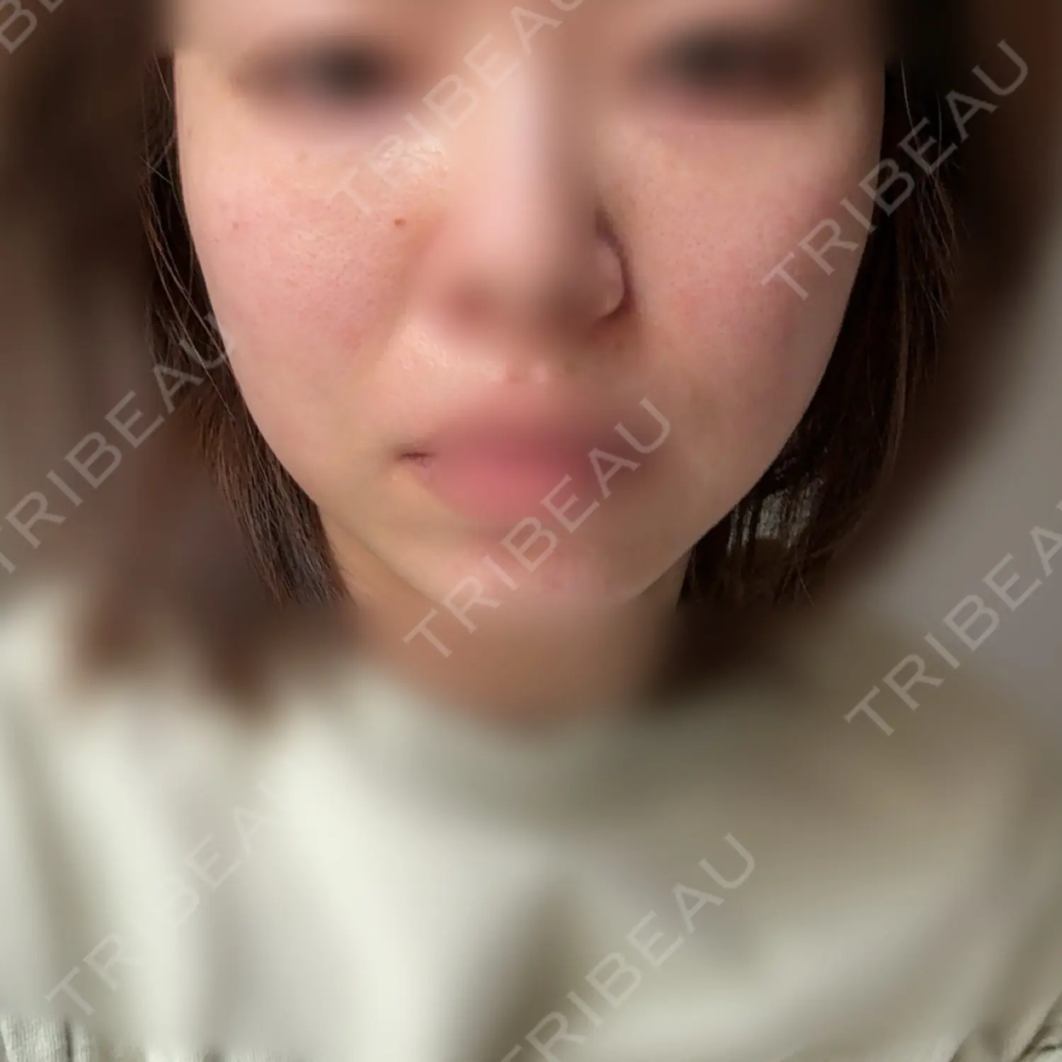 施術後の写真