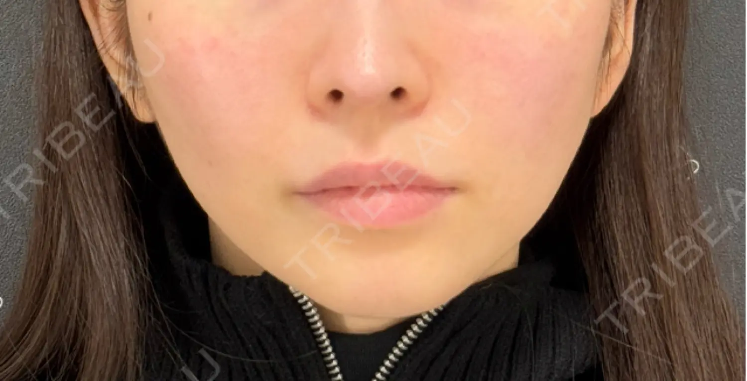 施術後の写真
