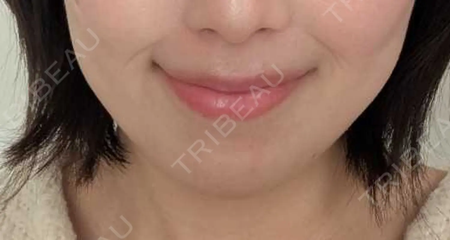 施術後の写真