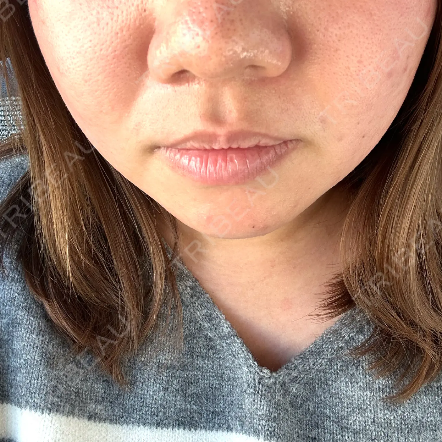 施術後の写真