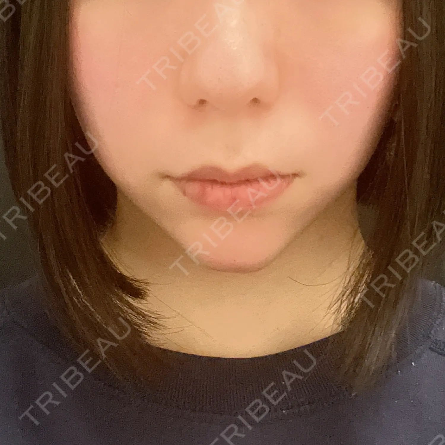 施術後の写真
