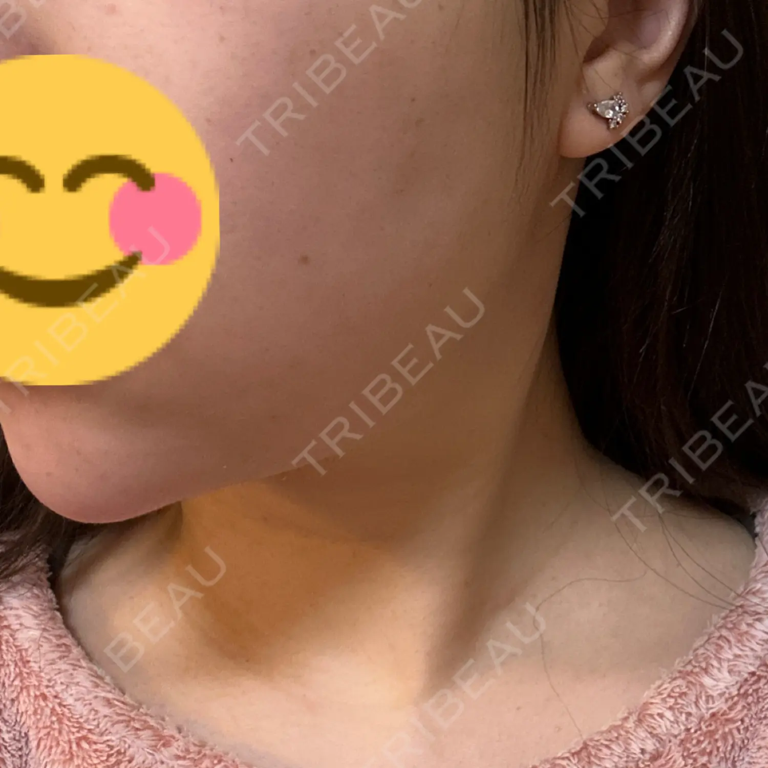 施術後の写真