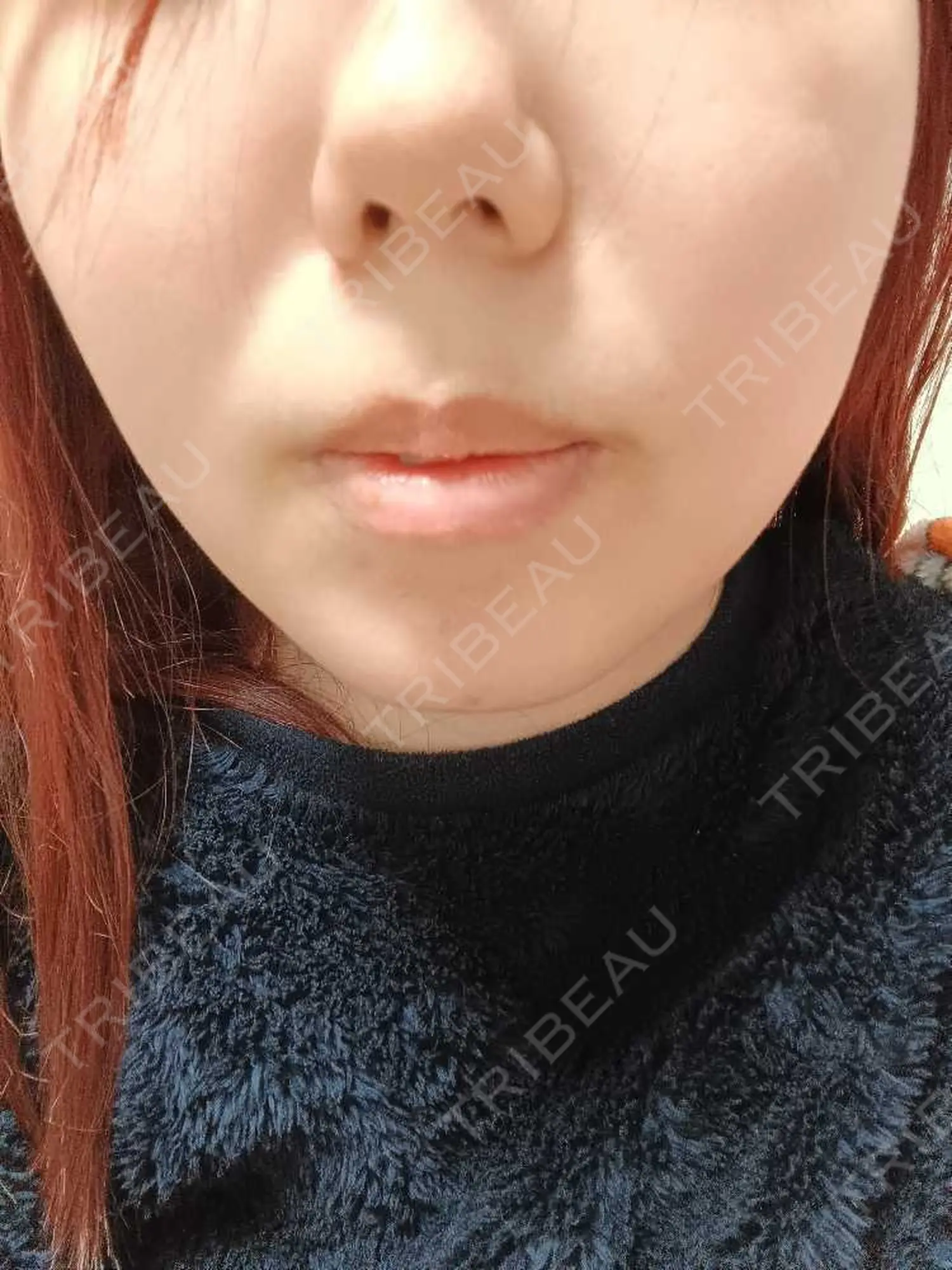 施術後の写真