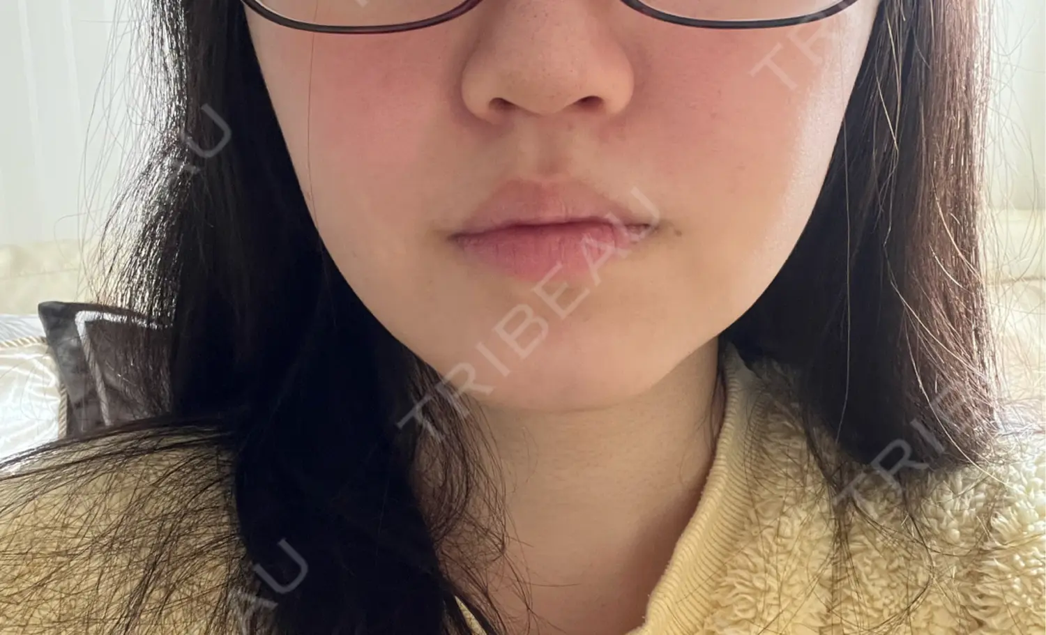 施術後の写真