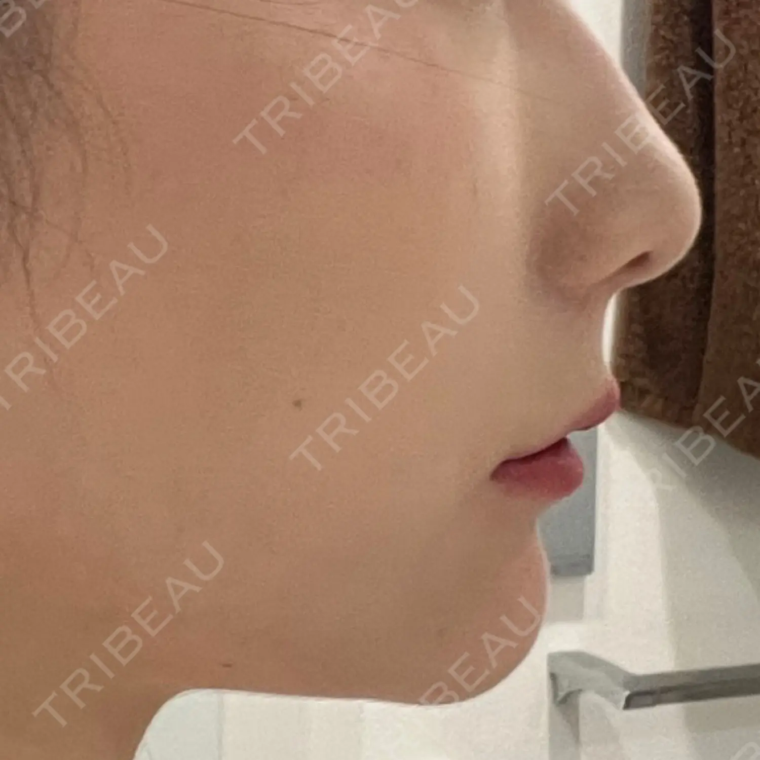 施術後の写真