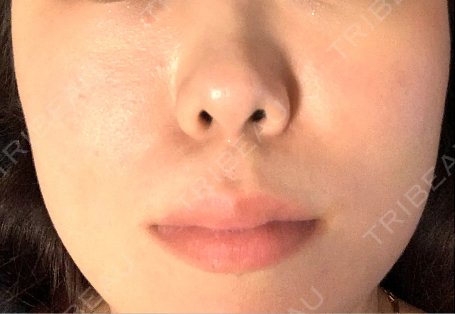 施術後の写真