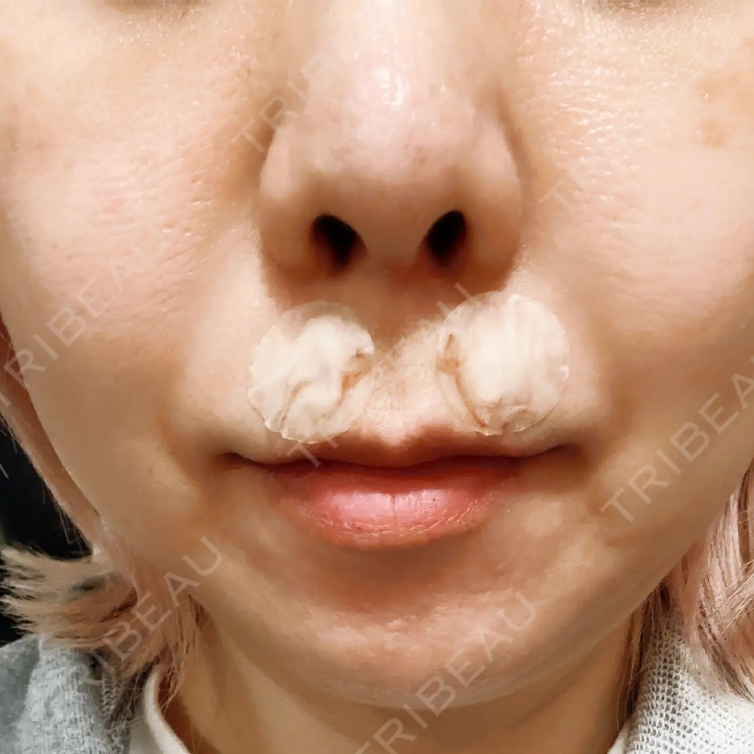 施術後の写真
