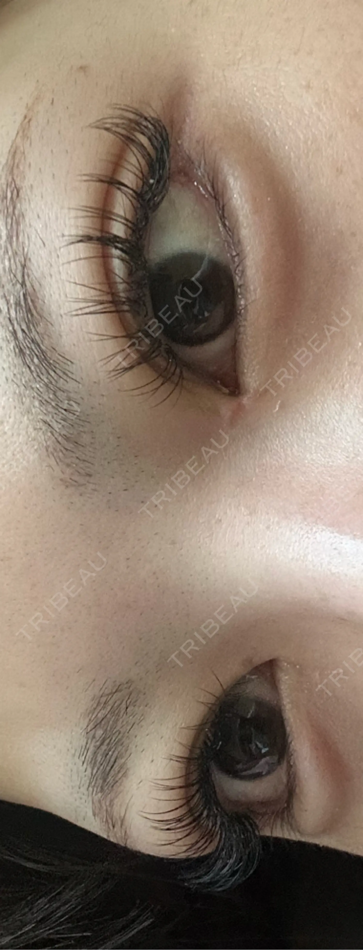 施術後の写真