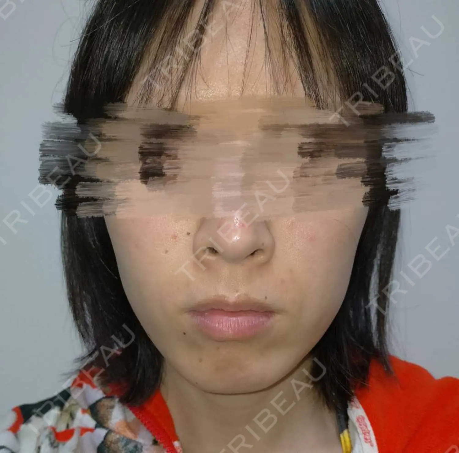 施術後の写真