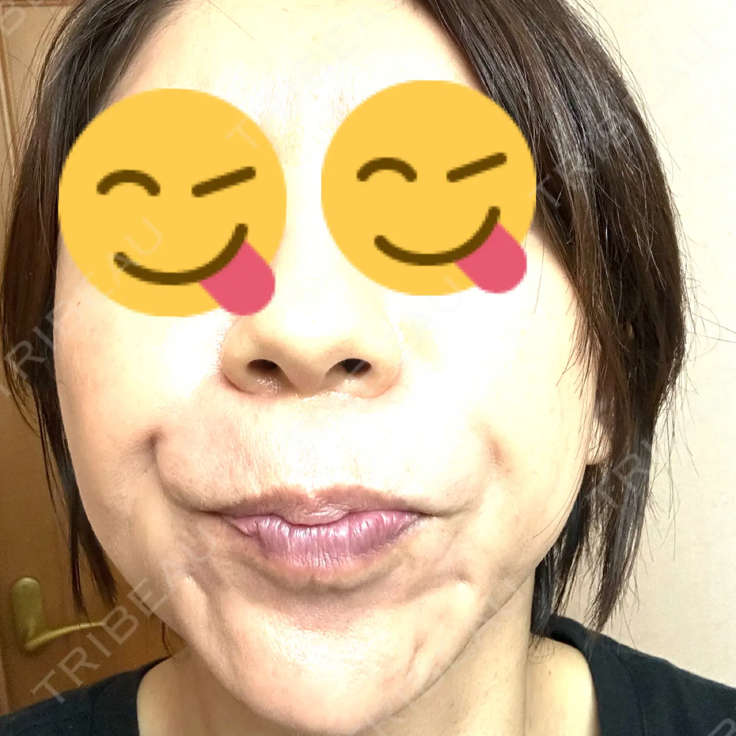 施術後の写真