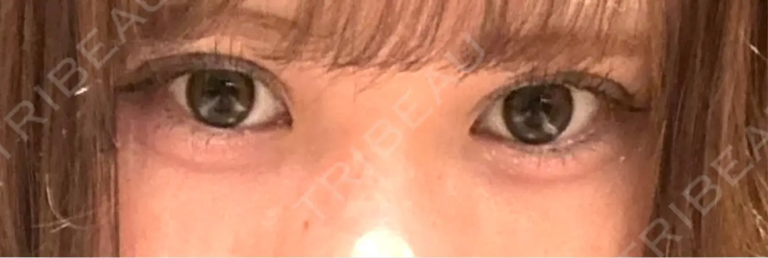 施術後の写真