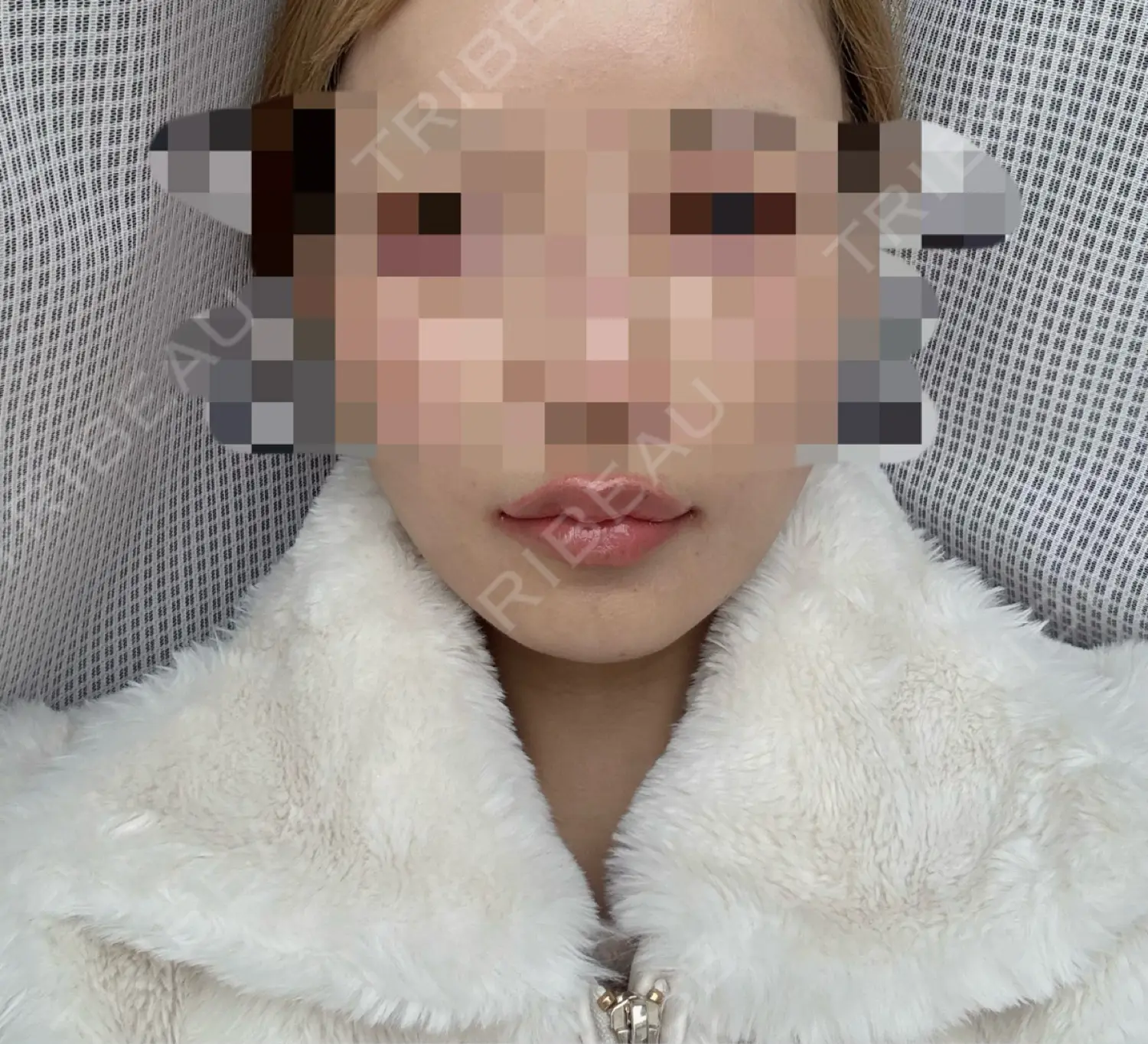 施術後の写真