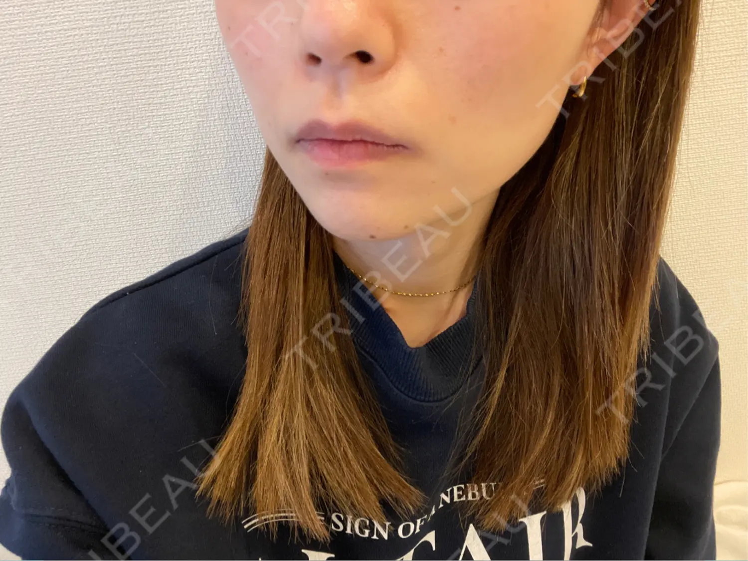 施術後の写真