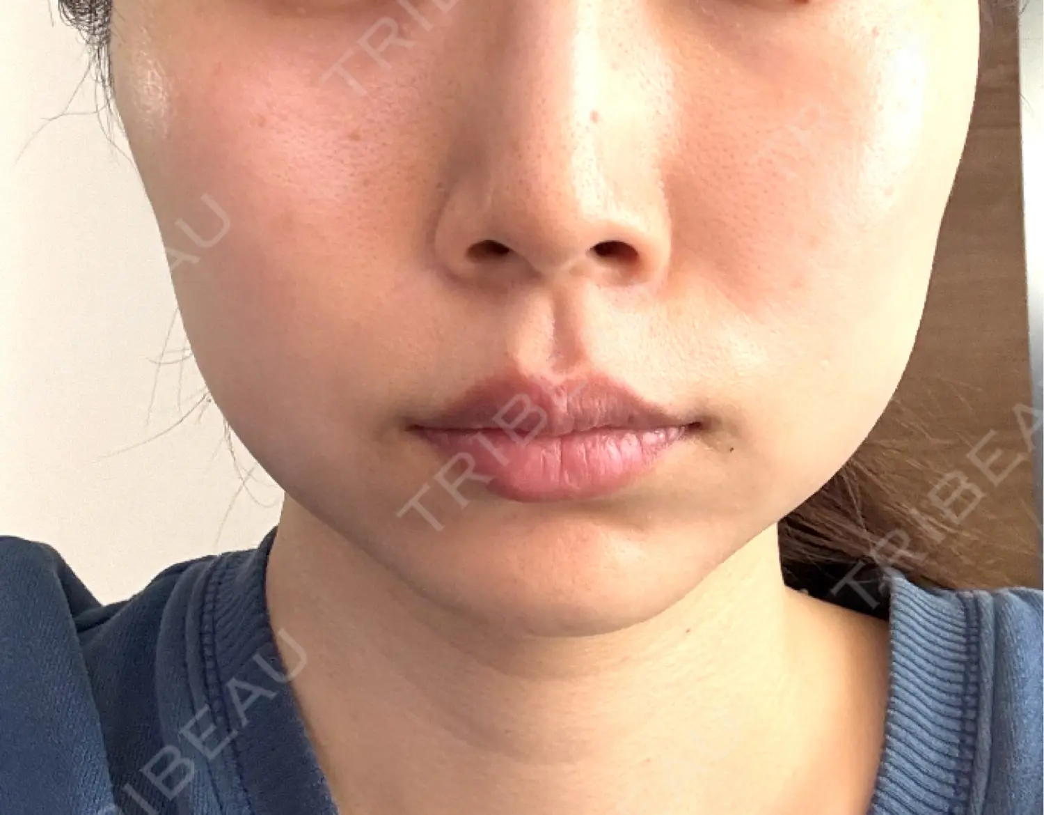 施術後の写真