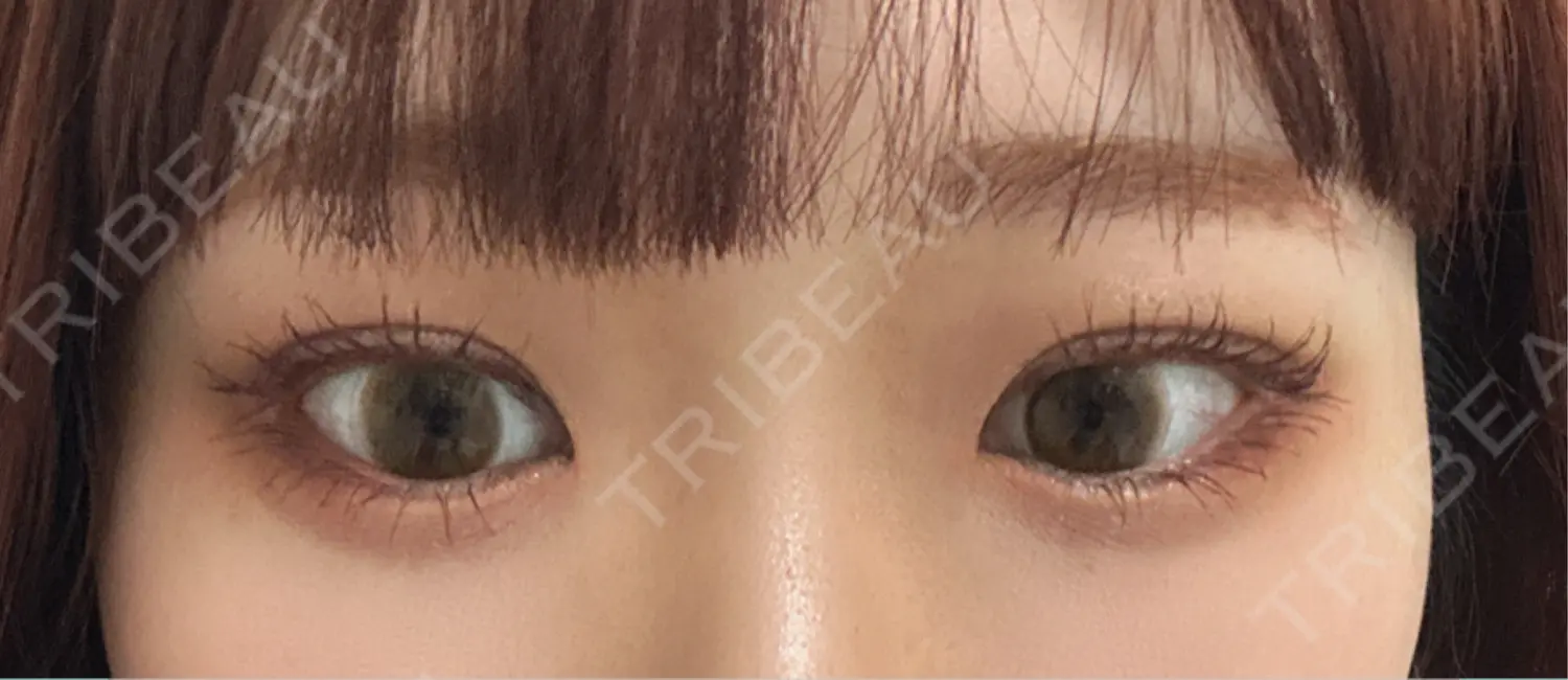 施術後の写真