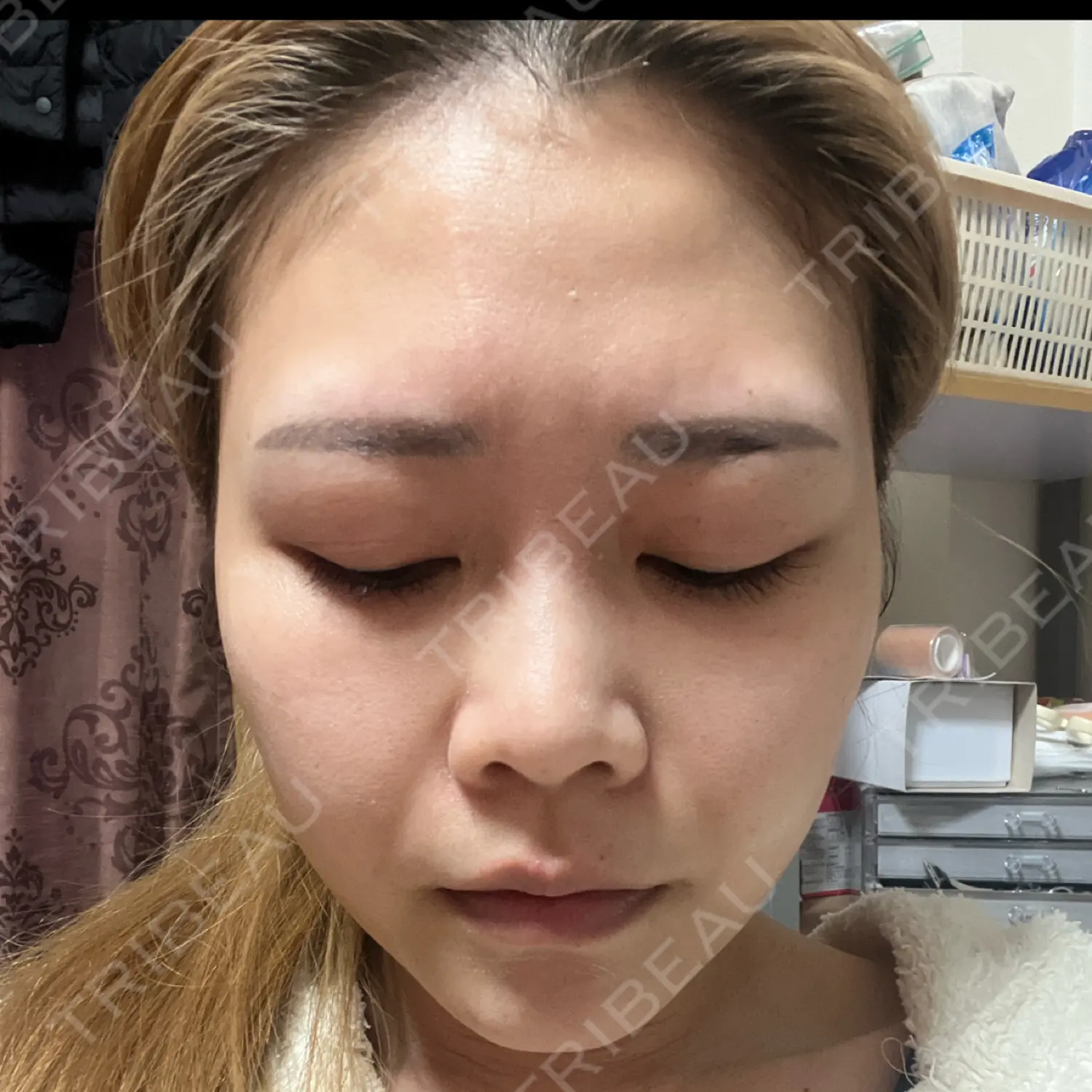 施術後の写真