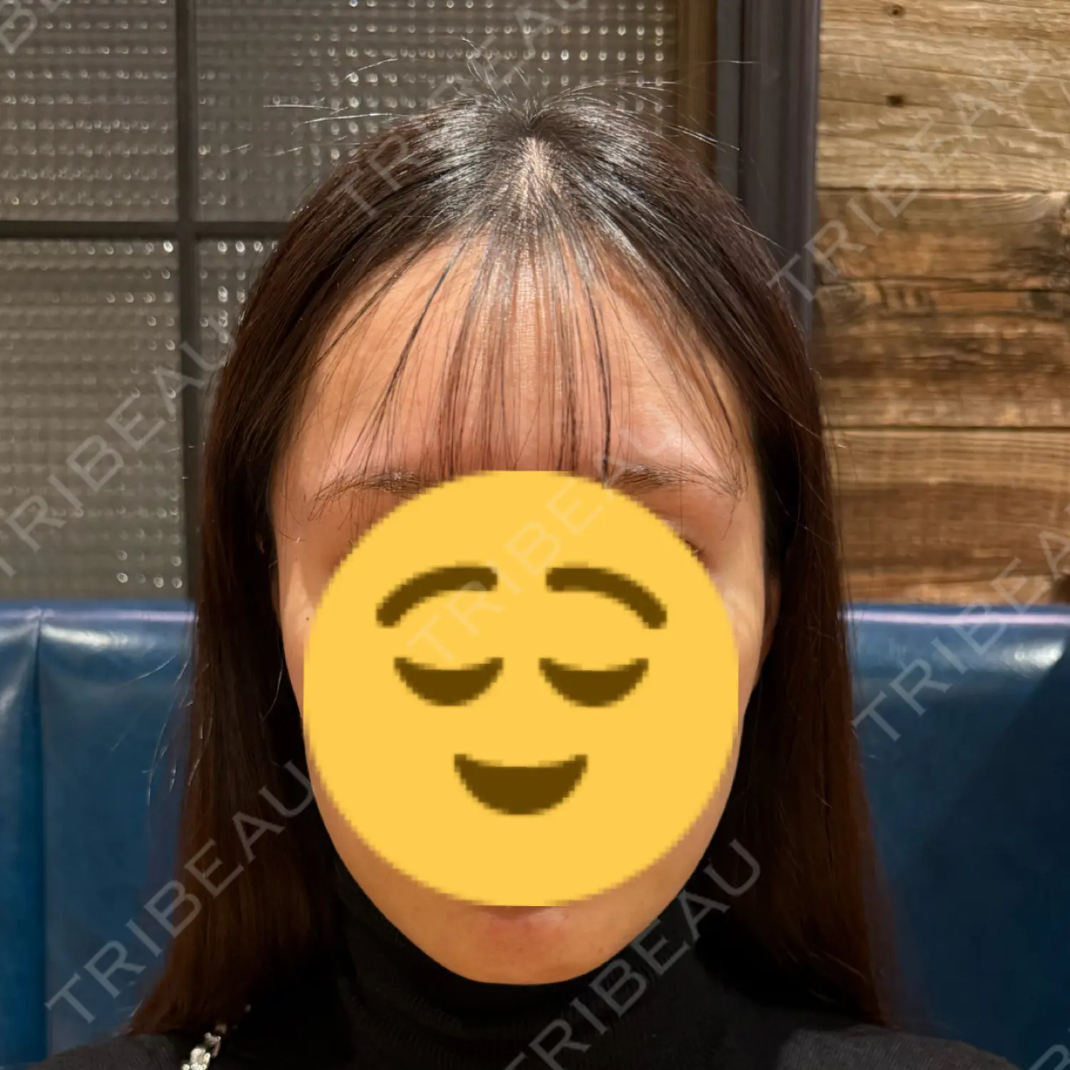 施術後の写真
