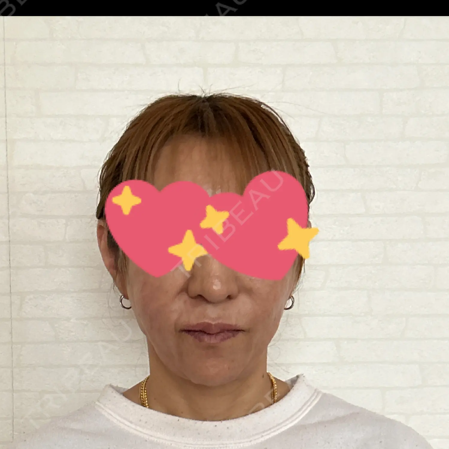 施術後の写真