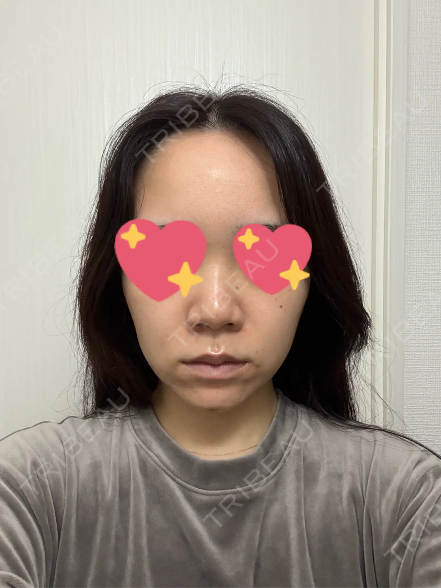 施術後の写真