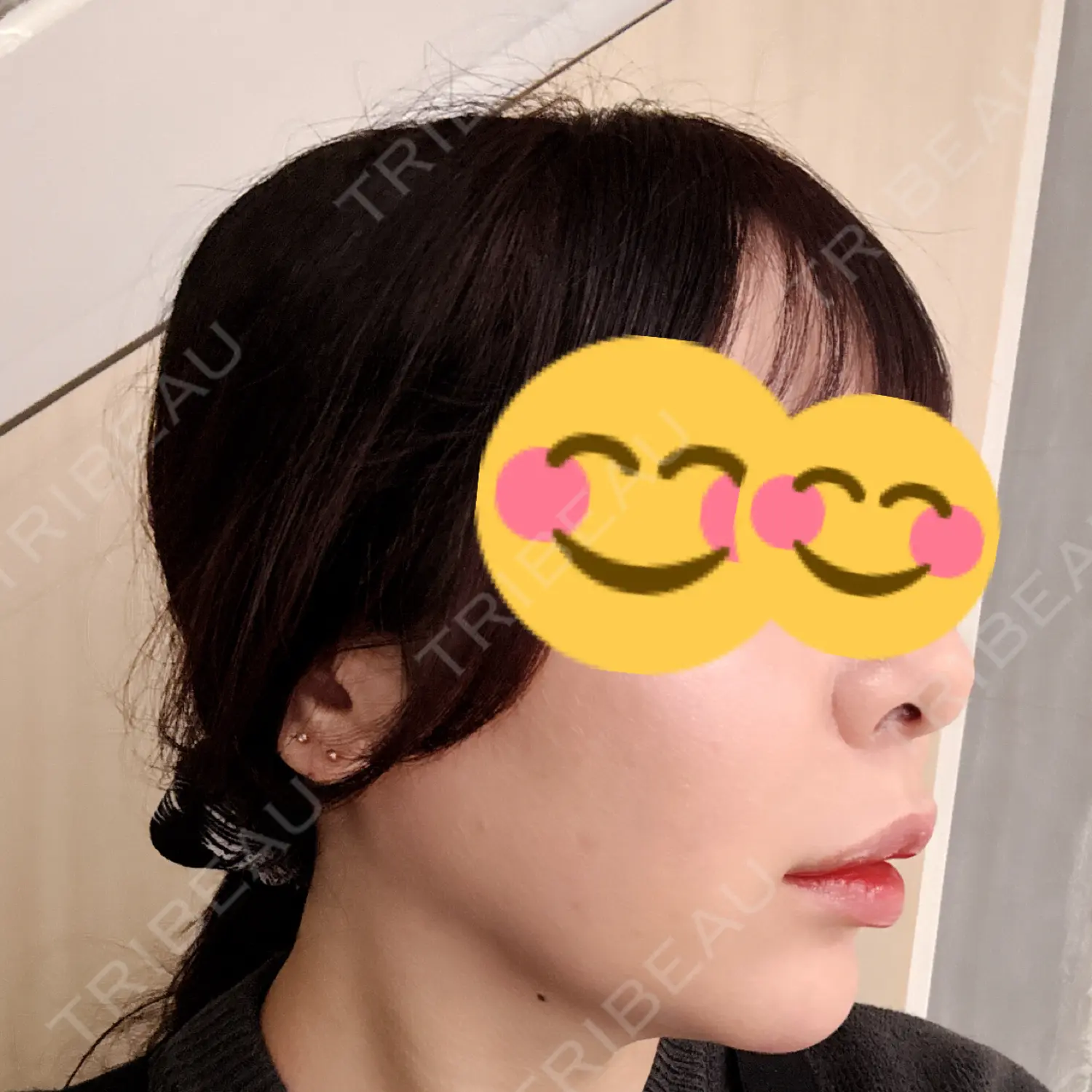 施術後の写真